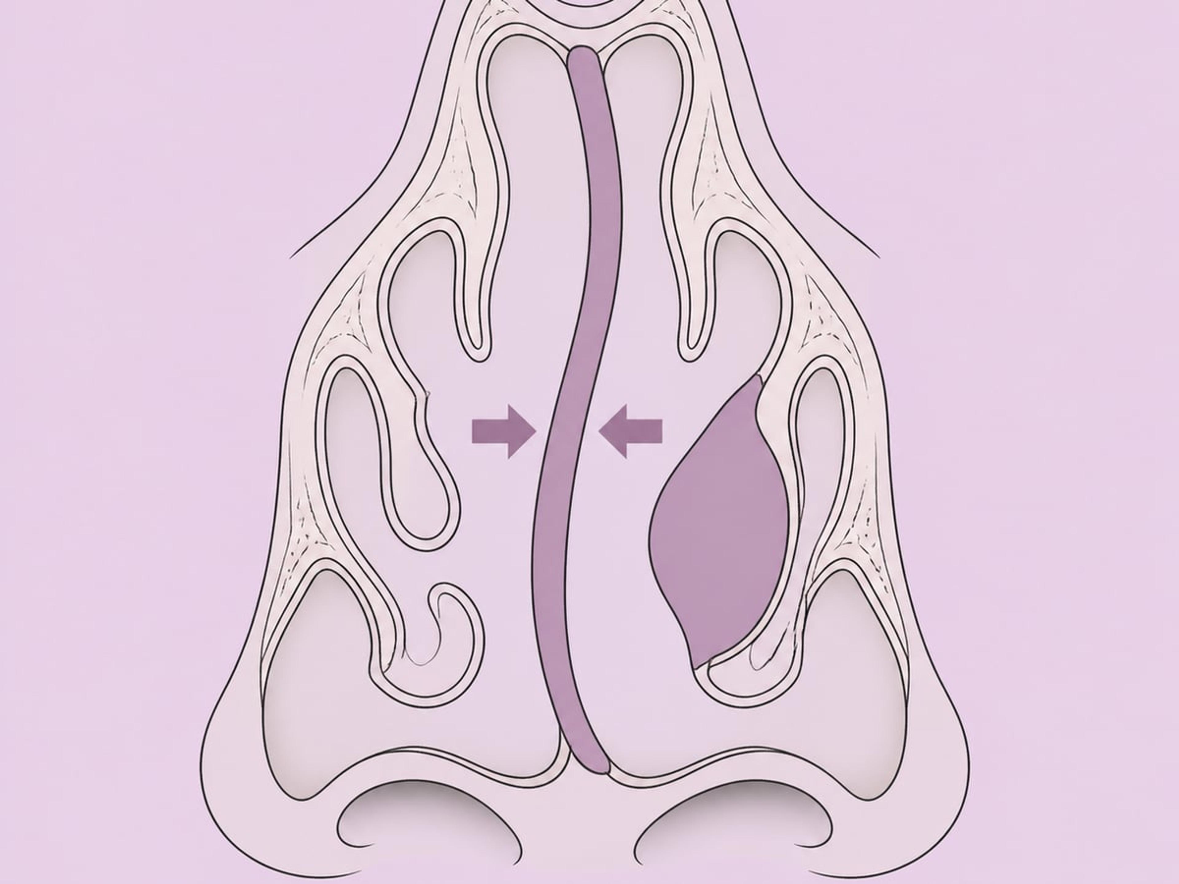 Septorhinoplastik — illustration