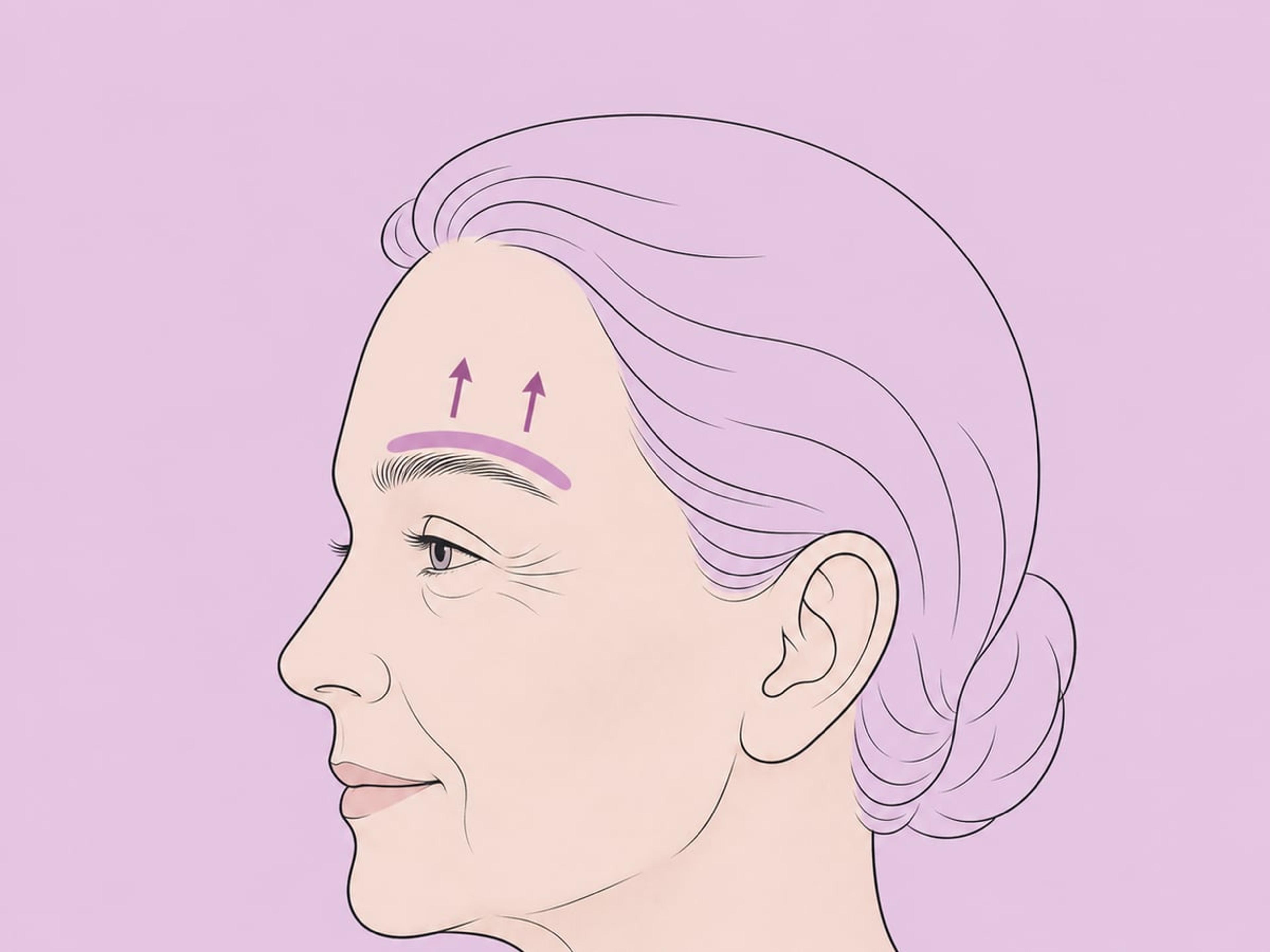 Direktes Brauenlifting — illustration