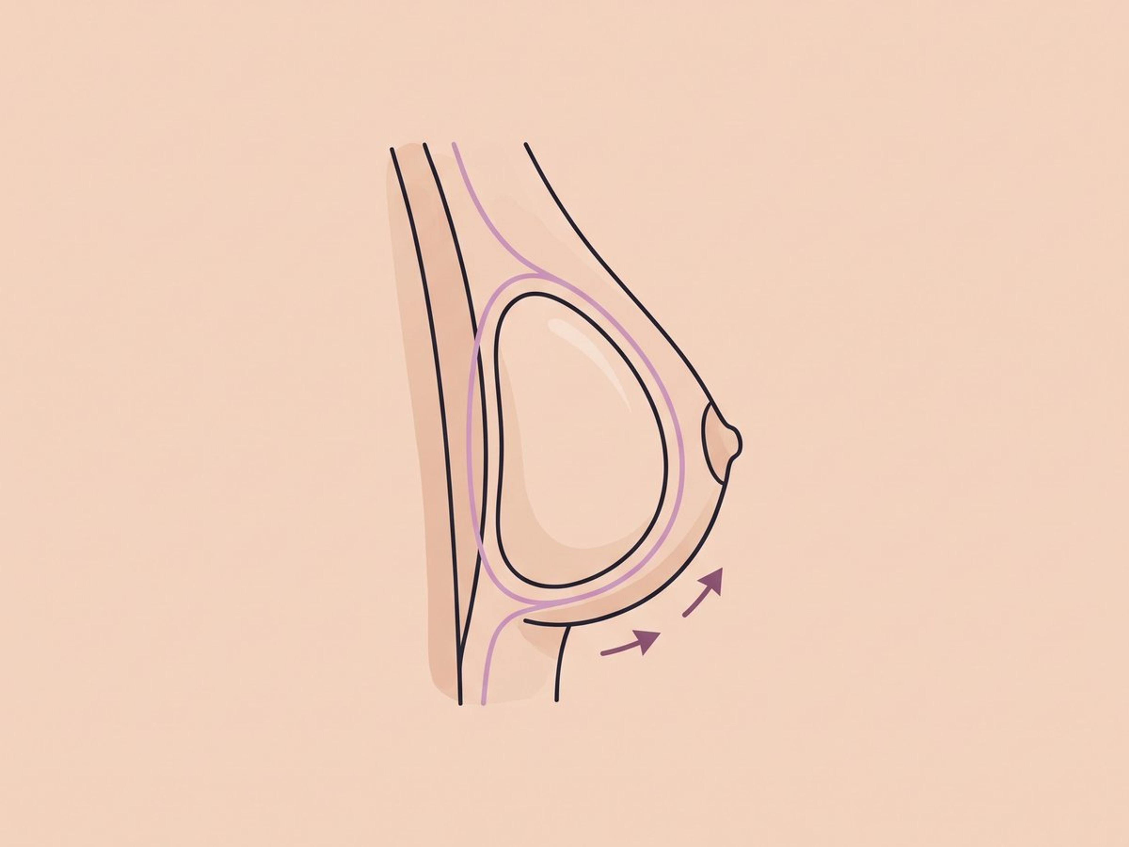Partielle oder vollständige Kapsulektomie — illustration