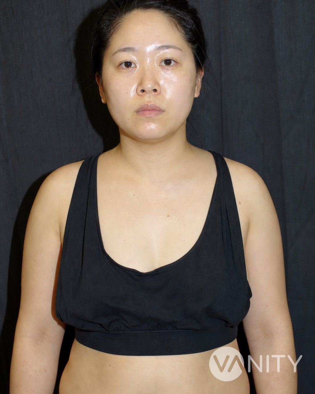 Before Breast fat transfer — illustrative, not a real patient