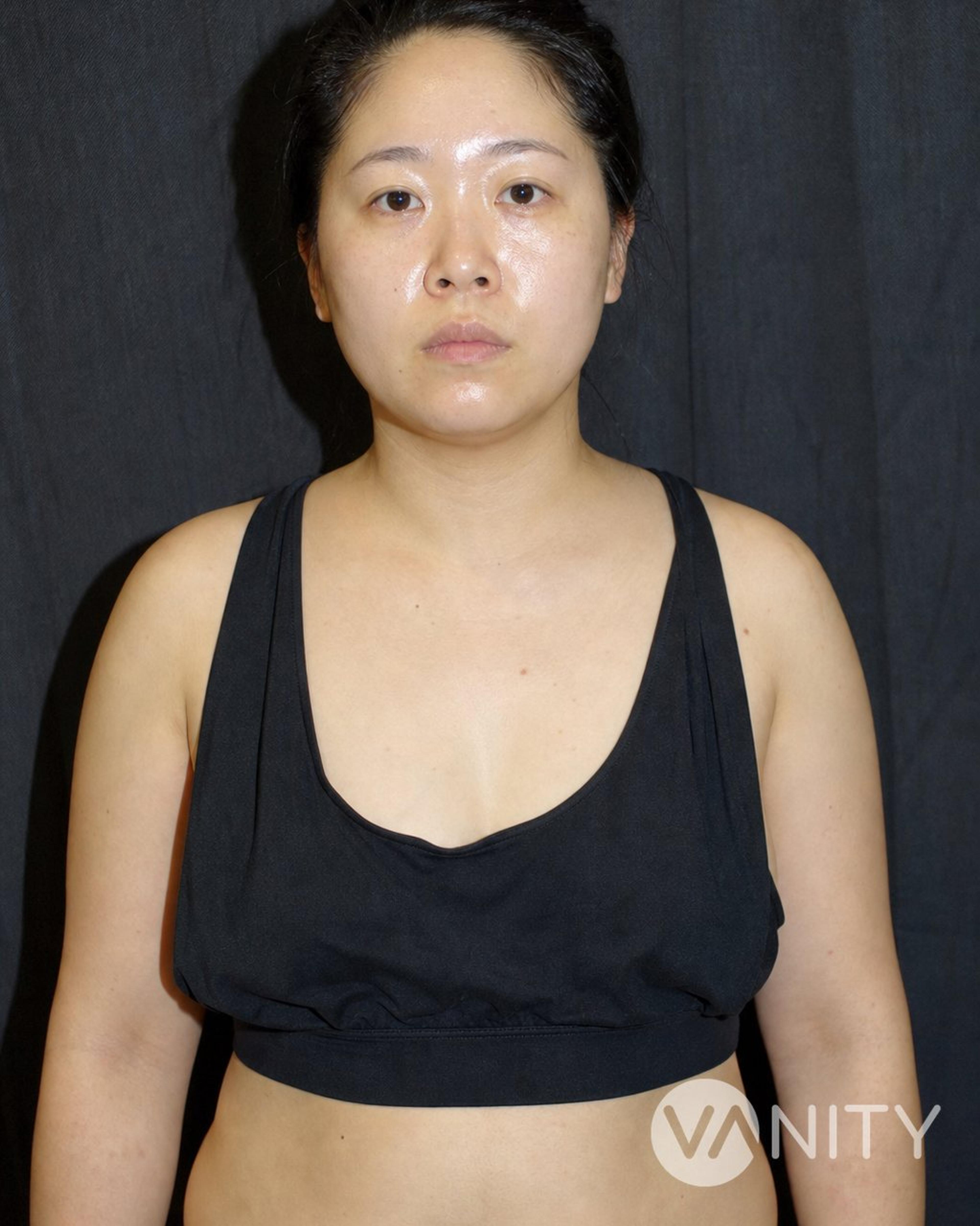 Before Breast fat transfer — illustrative, not a real patient