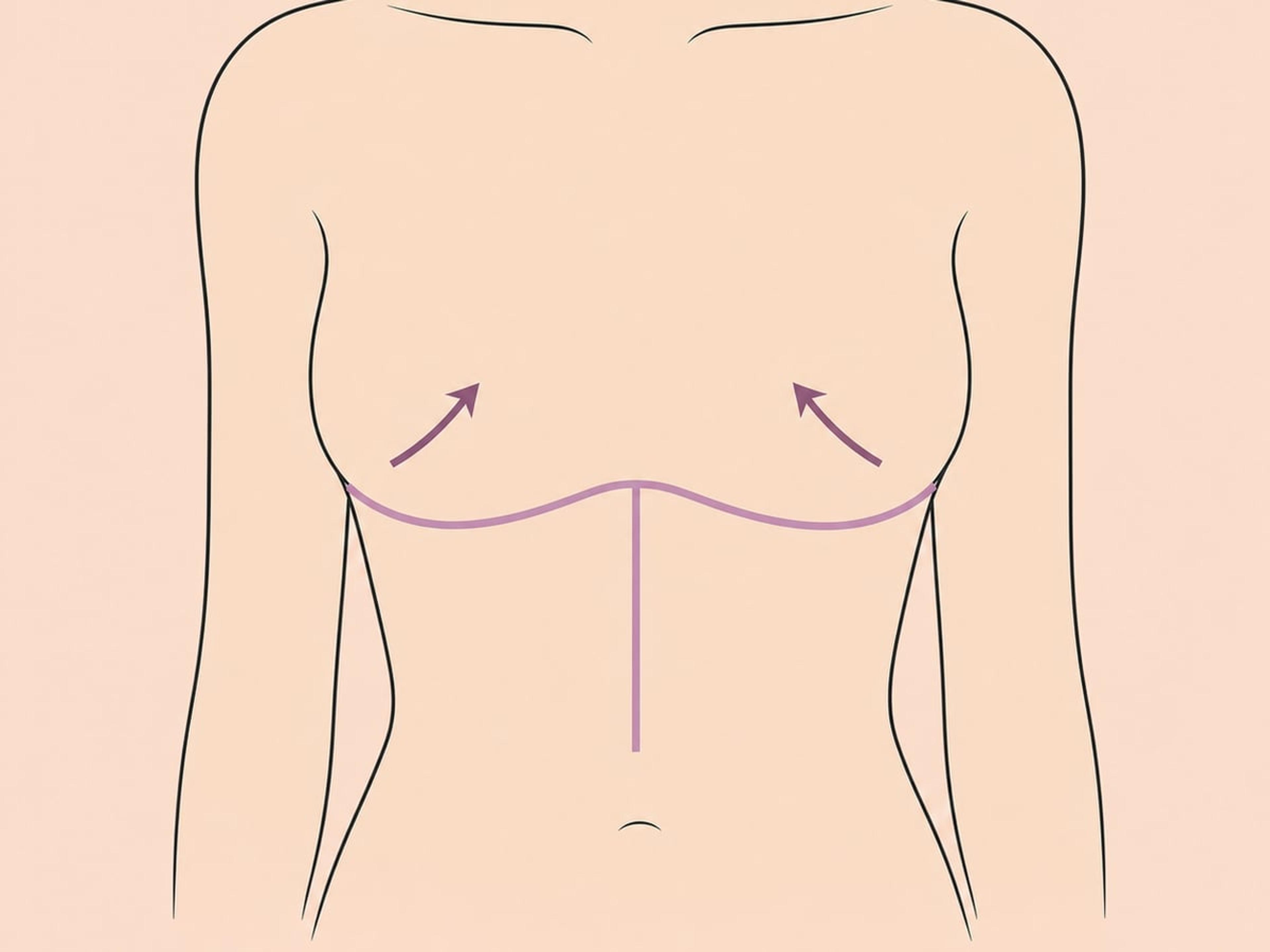 Anker- (umgekehrte-T-) Straffung — illustration