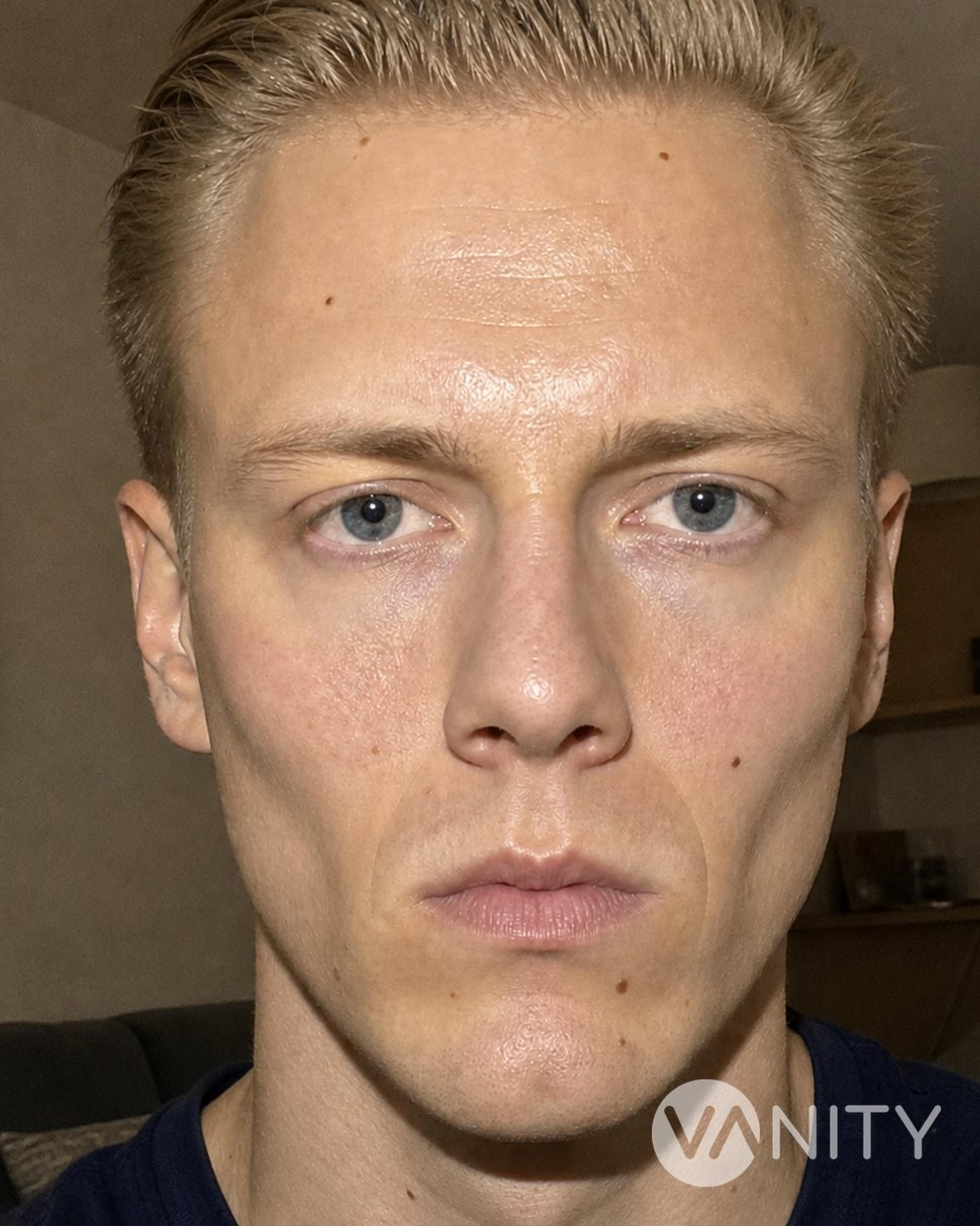 After Cheekbone implant — illustrative, not a real patient