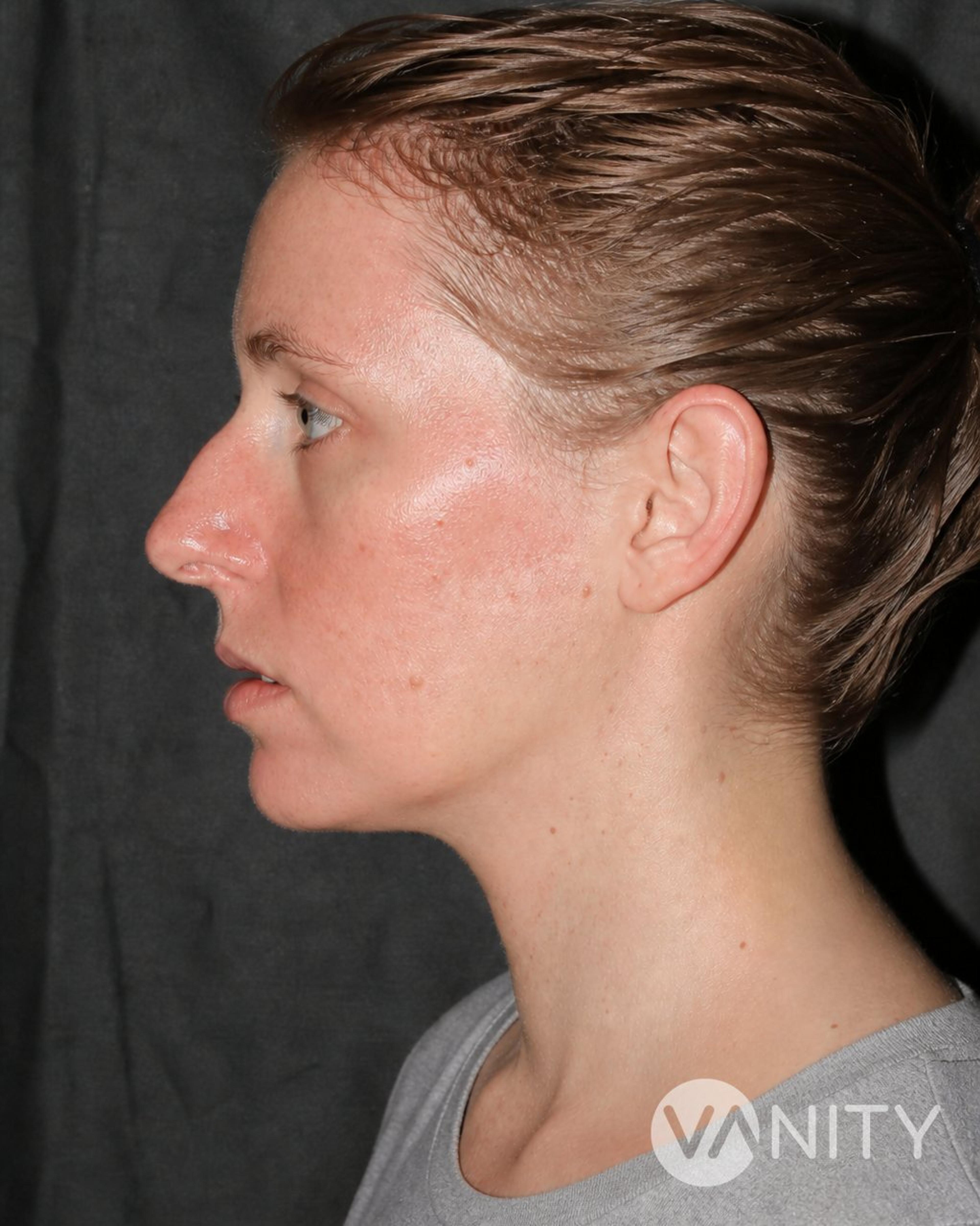 After Chin augmentation — illustrative, not a real patient