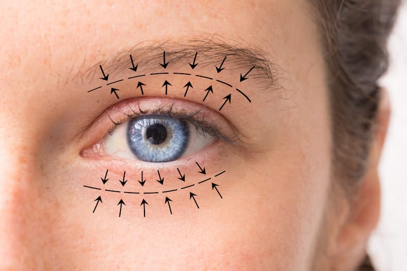 Eyelid Surgery in Turkey: What to Know Before You Book