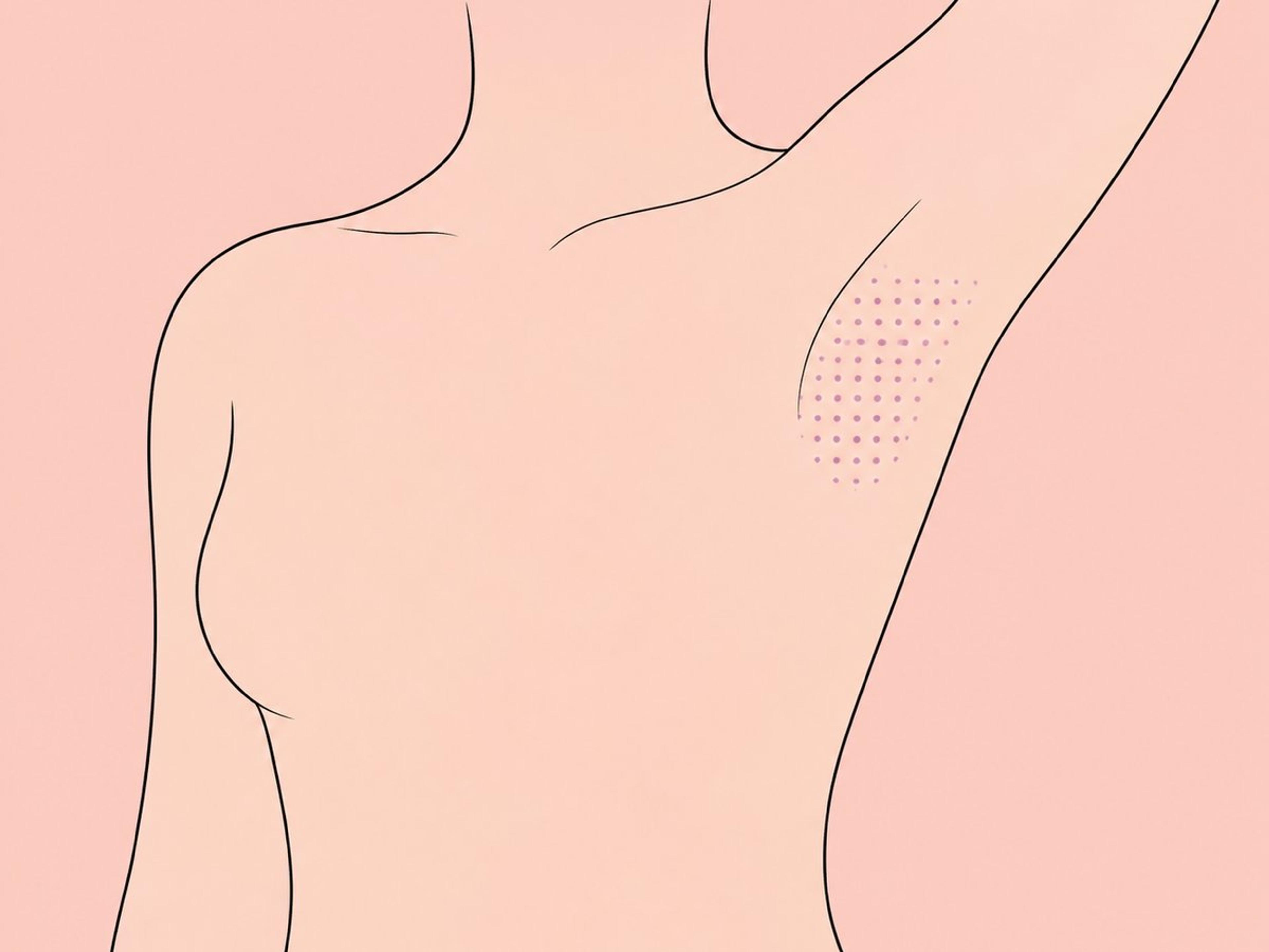 Botox bei Hyperhidrose — illustration