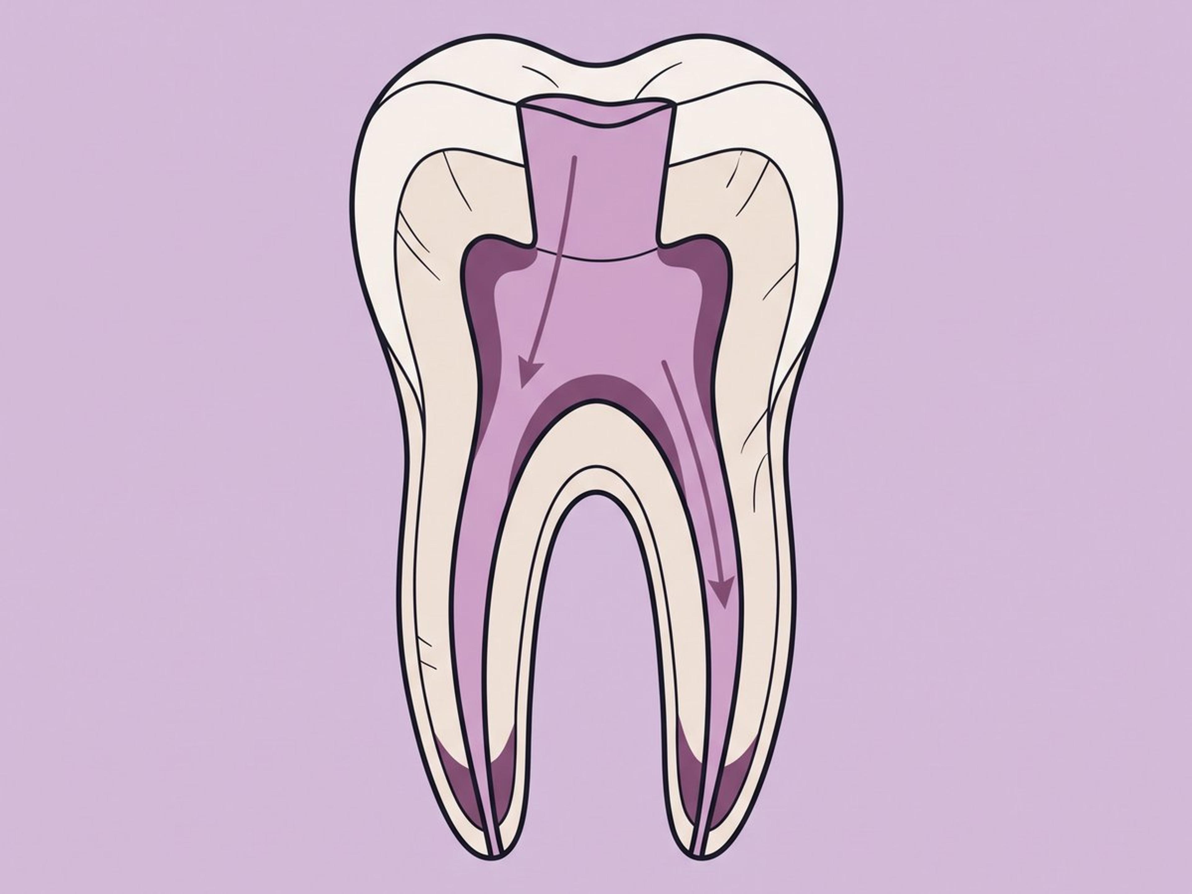 علاج قناة الجذر غير الجراحي — illustration