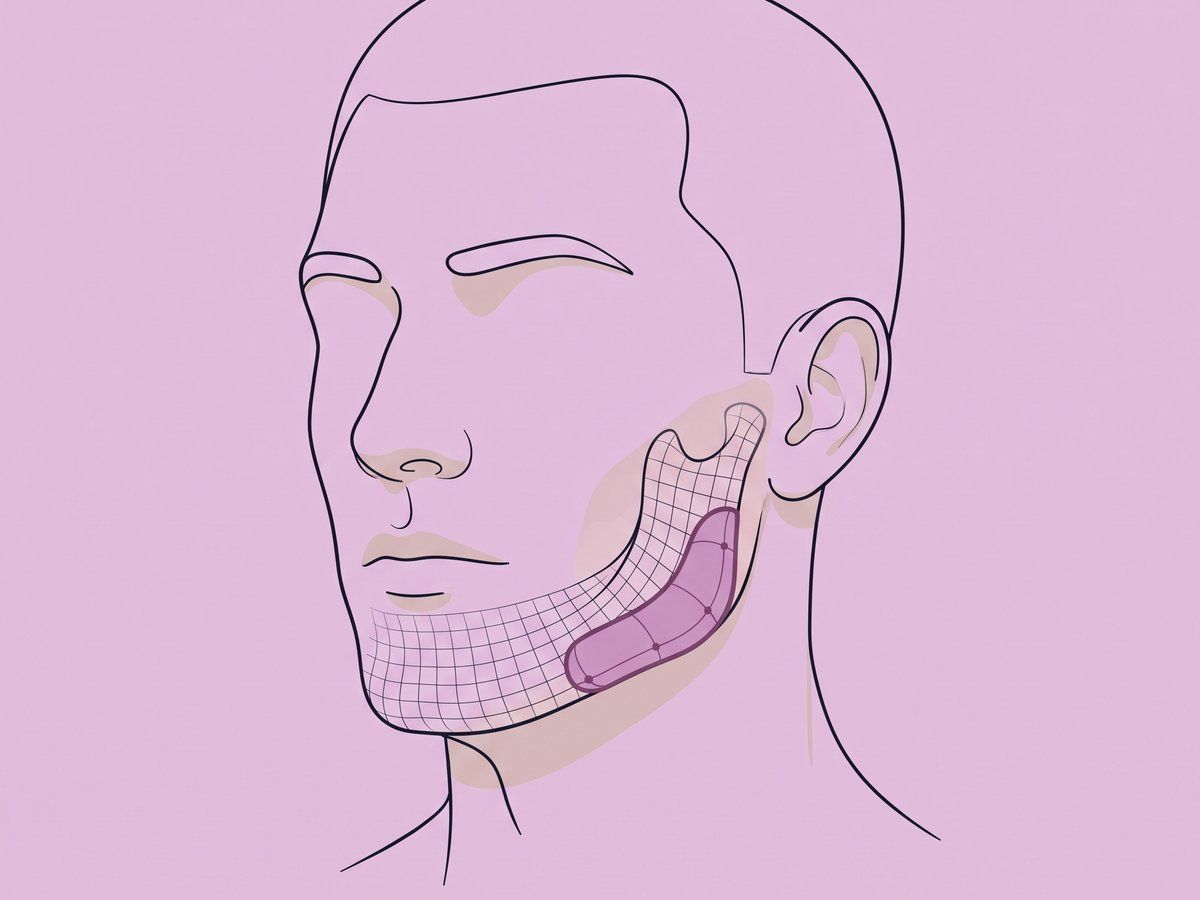 Implante combinado de línea mandibular y mentón — illustration
