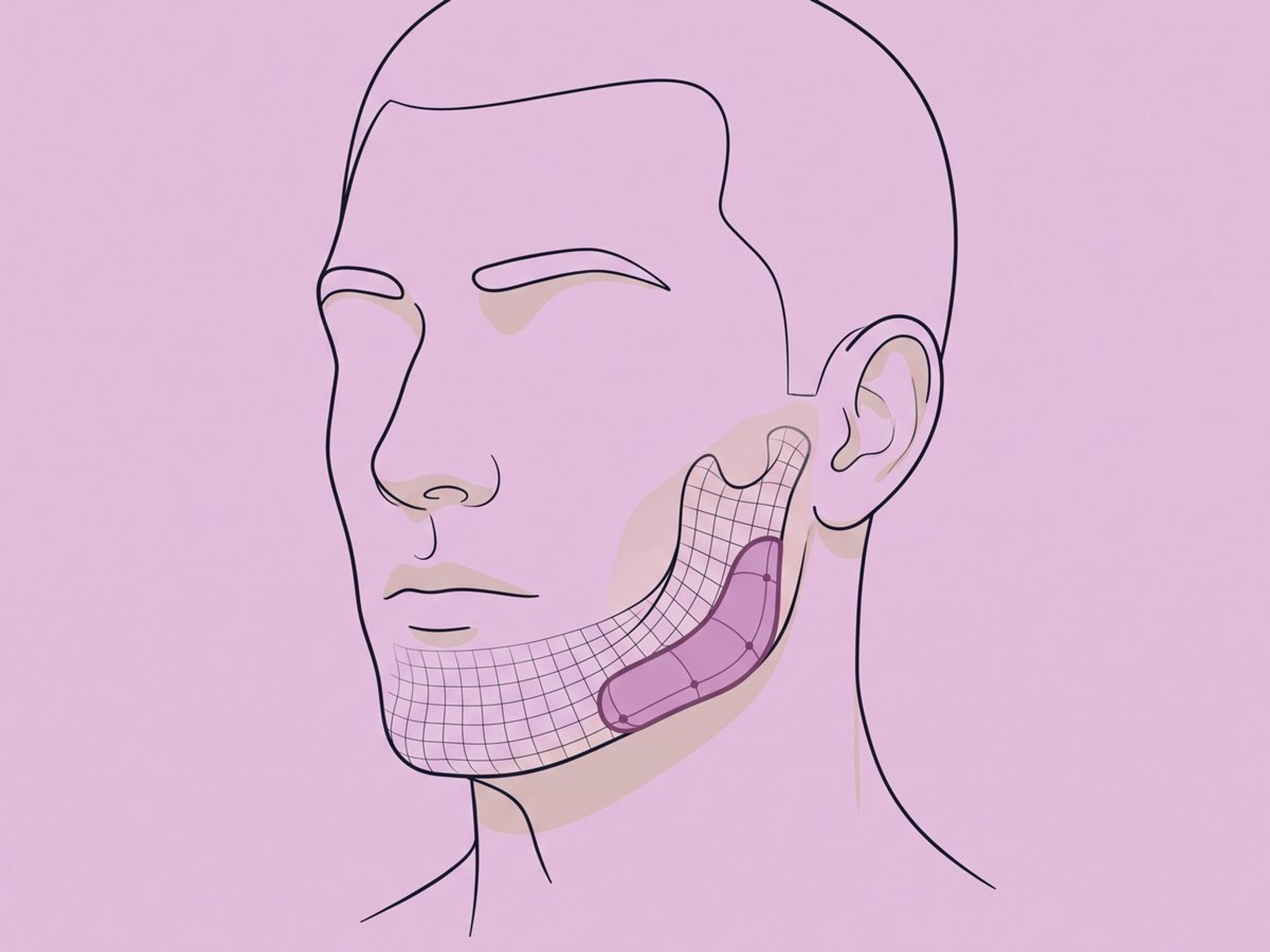 Implante combinado de línea mandibular y mentón — illustration