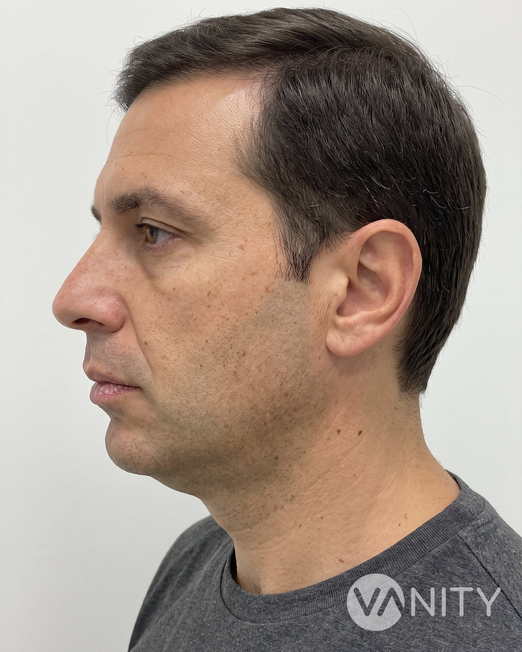 Before Dermal fillers — illustrative, not a real patient