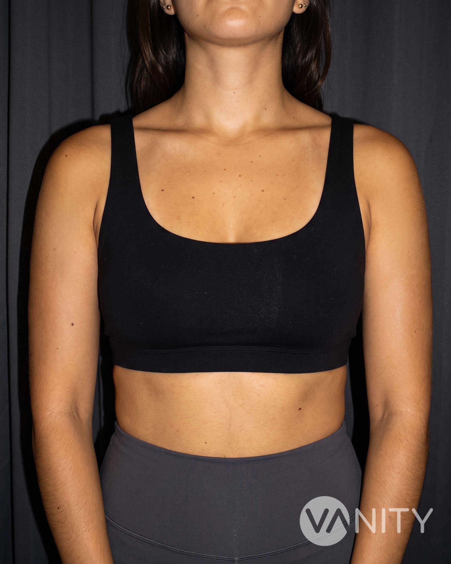 Before Breast augmentation — illustrative, not a real patient