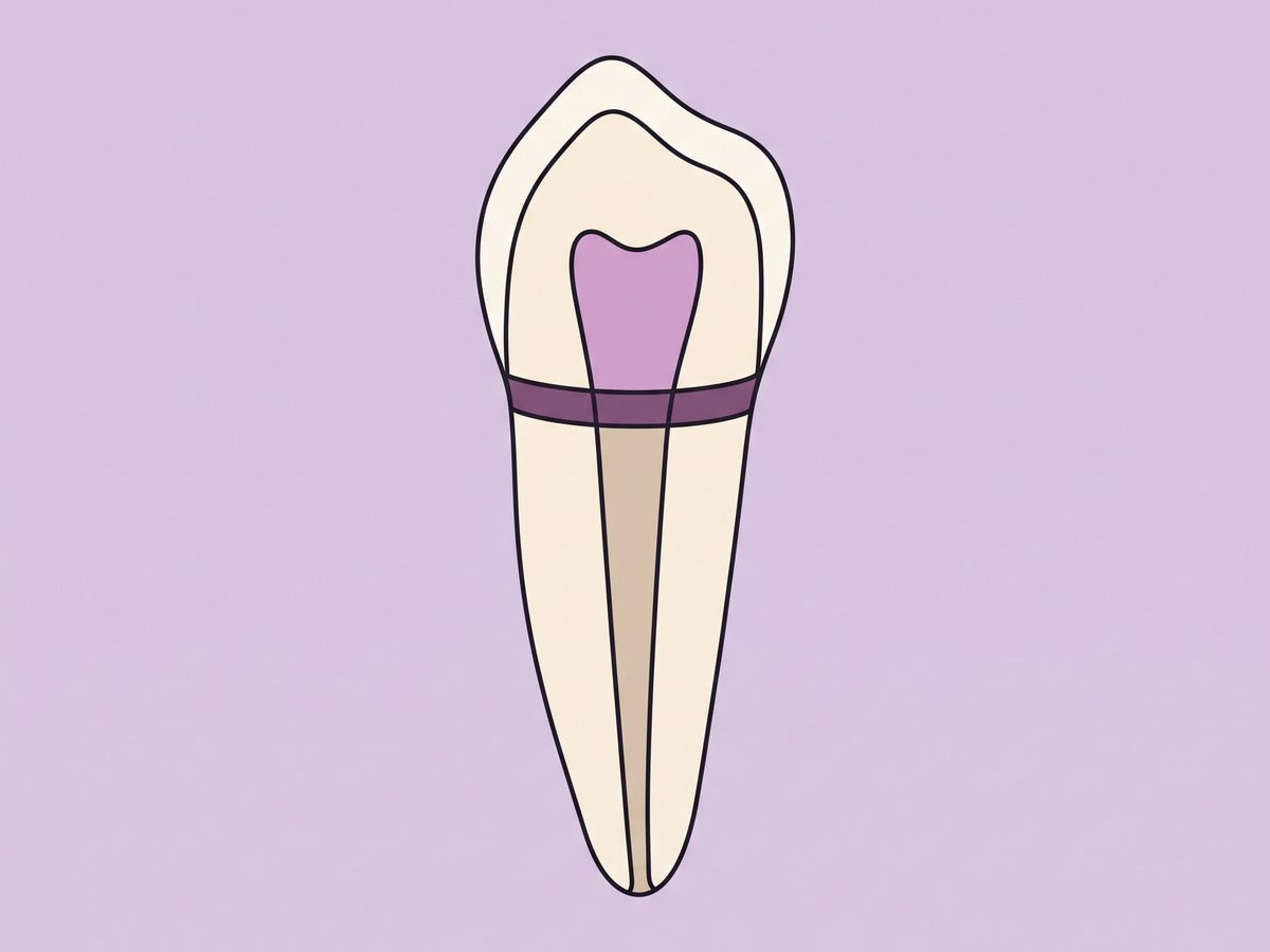 التبييض الداخلي لسن واحد معالج الجذر (غير حي) — illustration