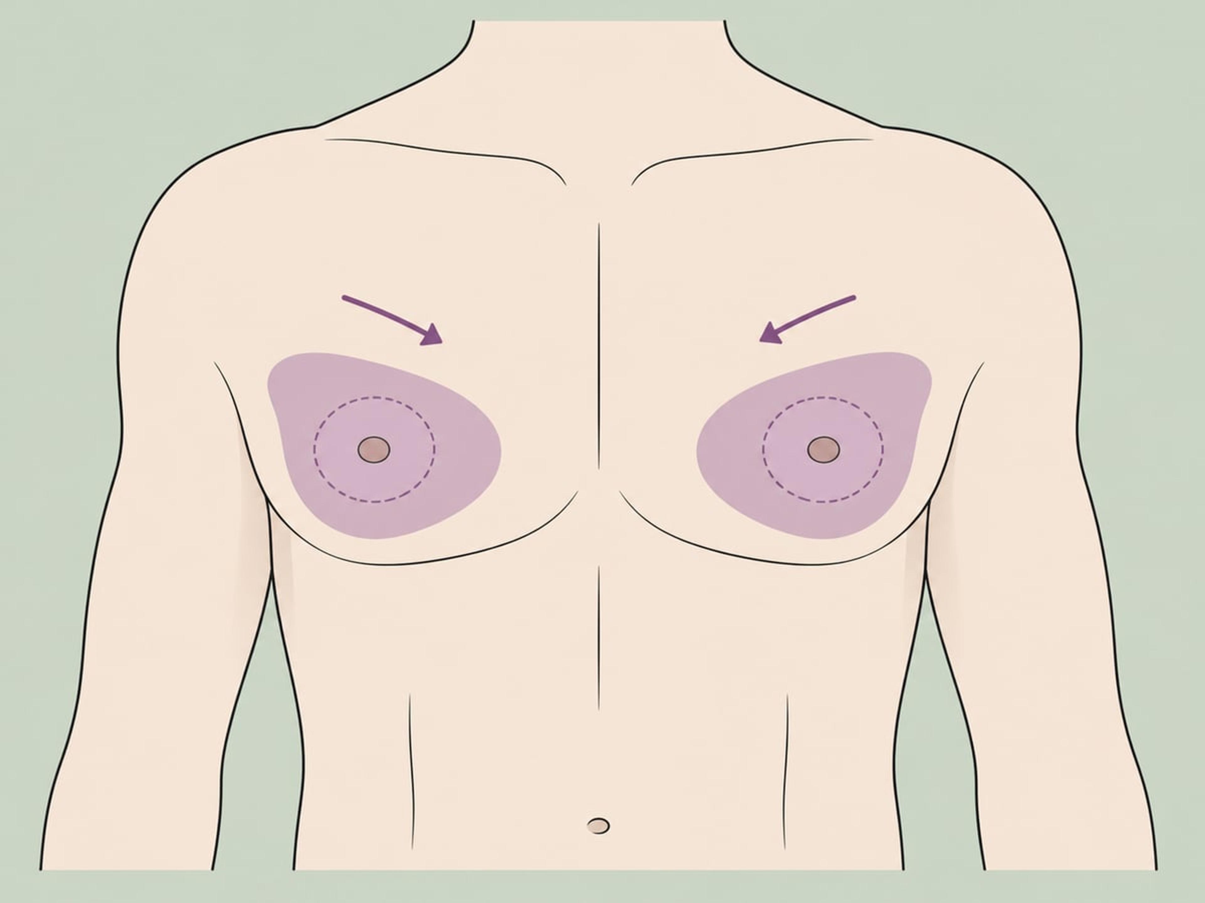 Nur Fettabsaugung — illustration