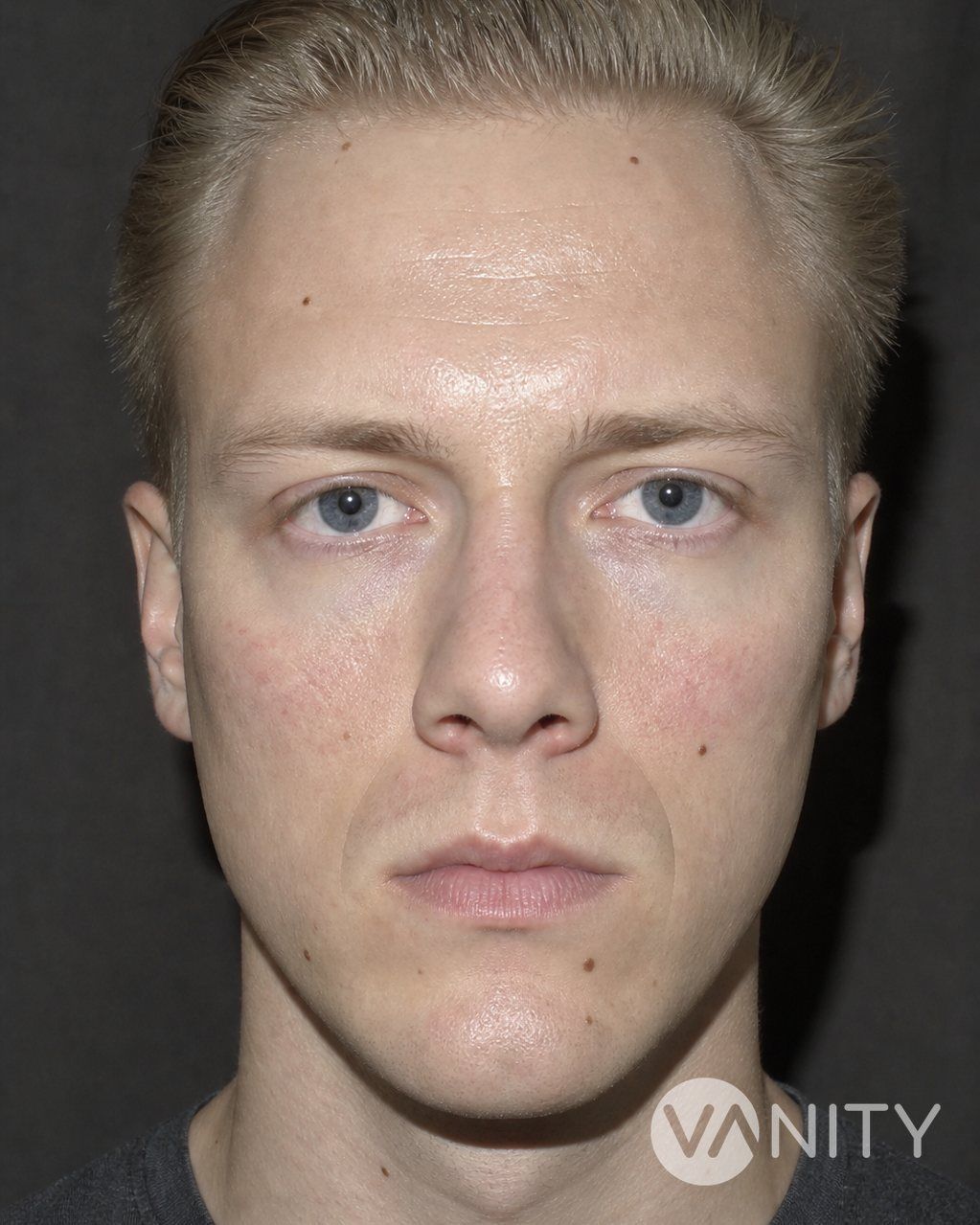 Before Cheekbone implant — illustrative, not a real patient