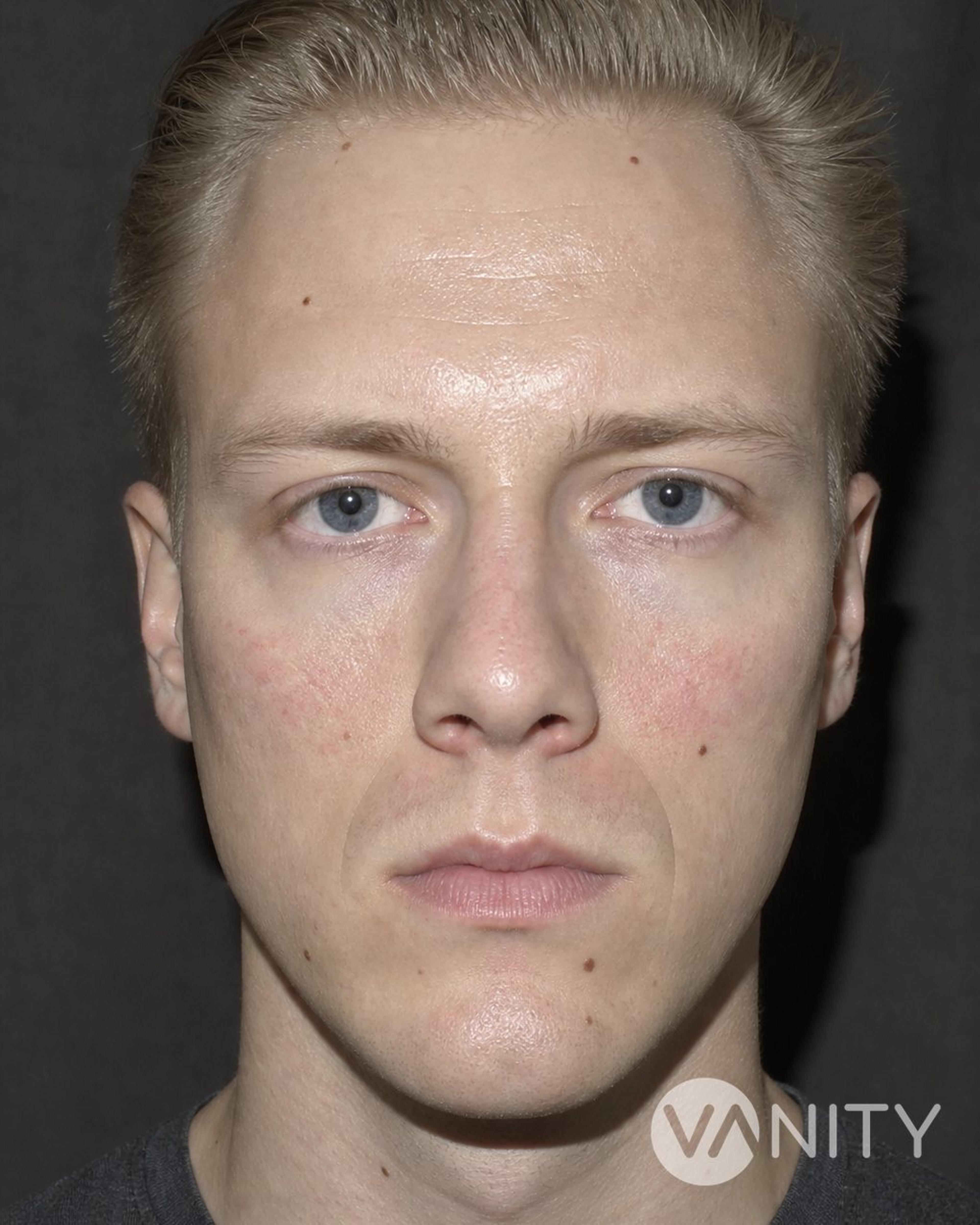 Before Cheekbone implant — illustrative, not a real patient