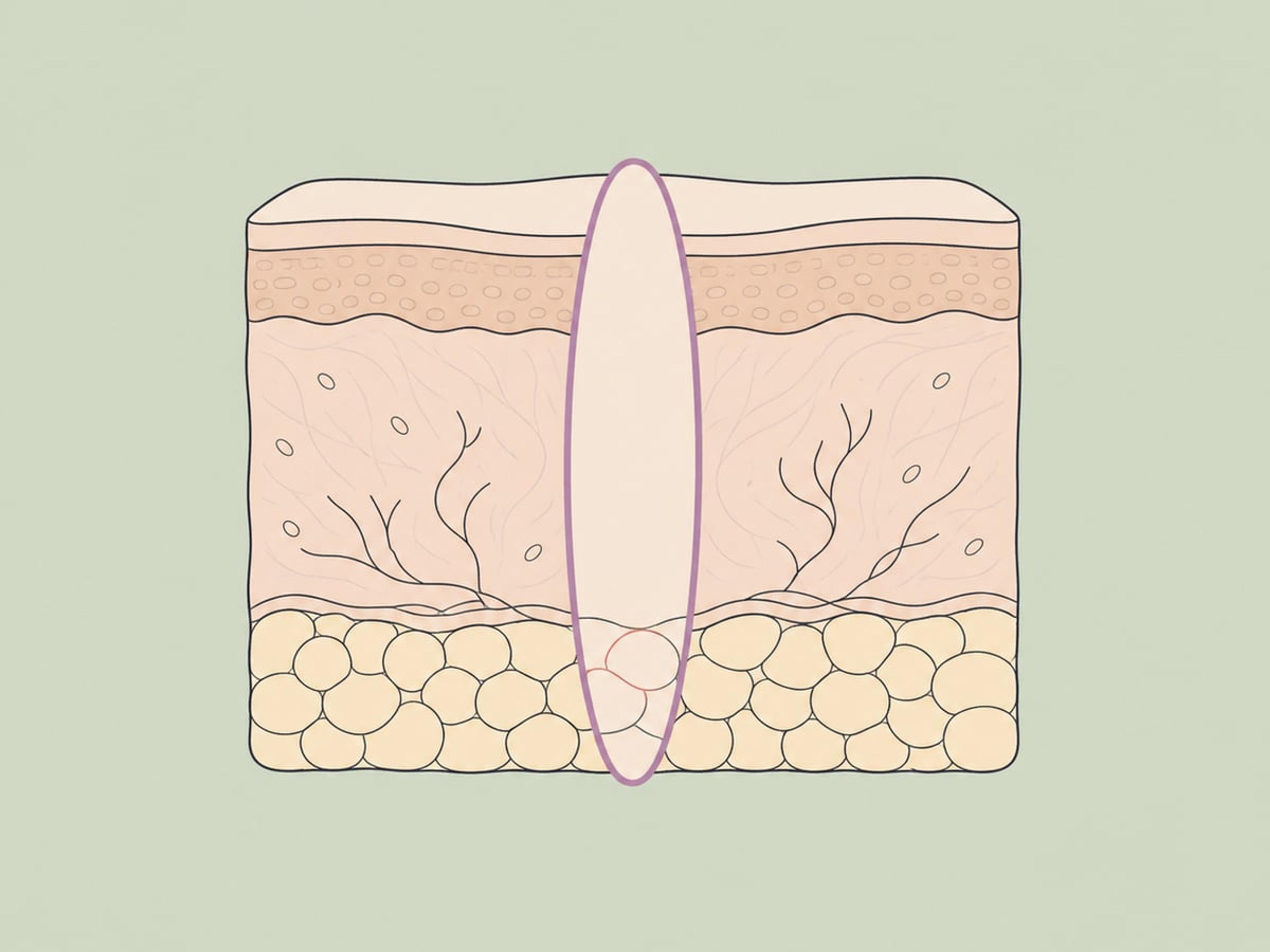 Full-thickness surgical excision — illustration