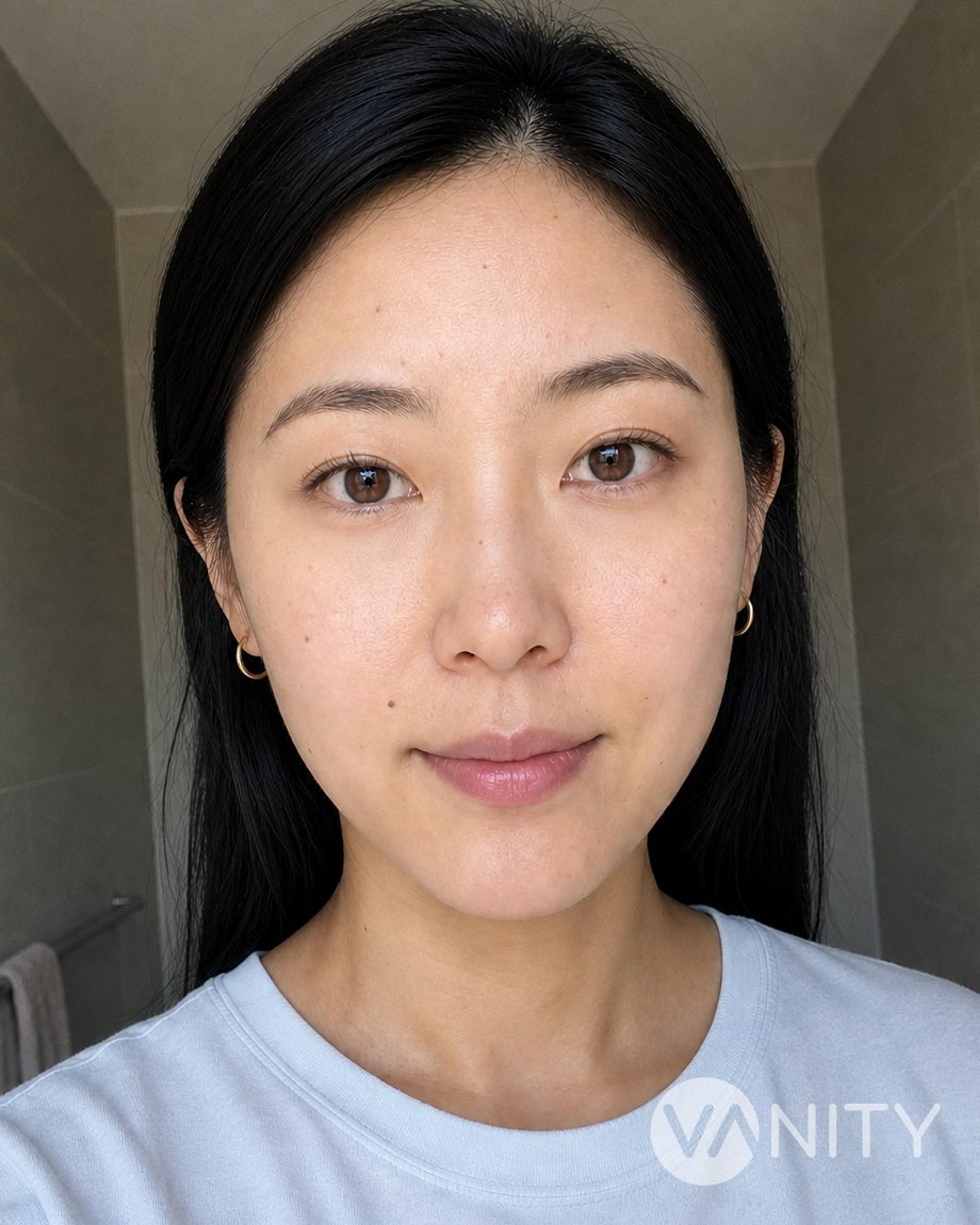 After Dark circles and under-eye treatment — illustrative, not a real patient