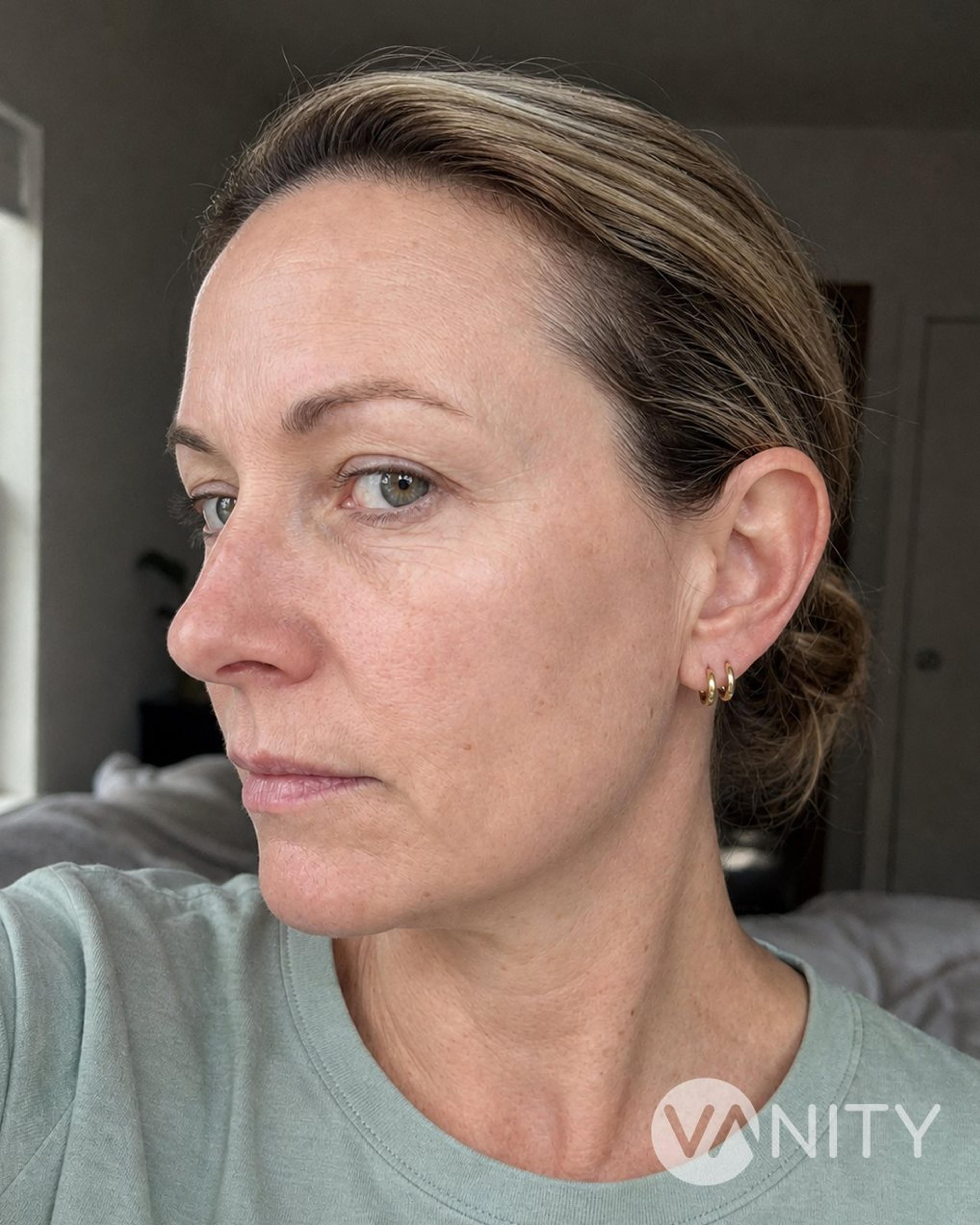 After Fractional laser — illustrative, not a real patient
