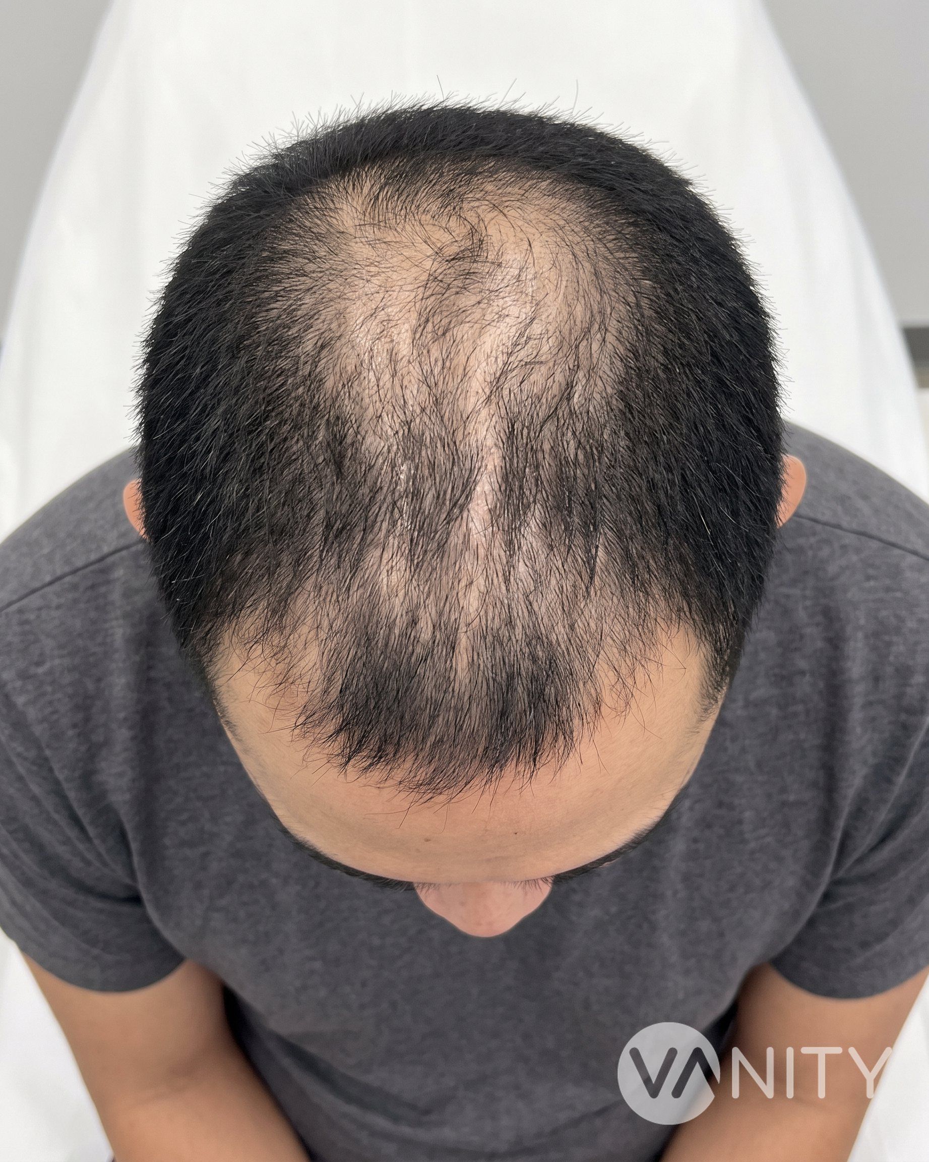 Before PRP therapy — illustrative, not a real patient