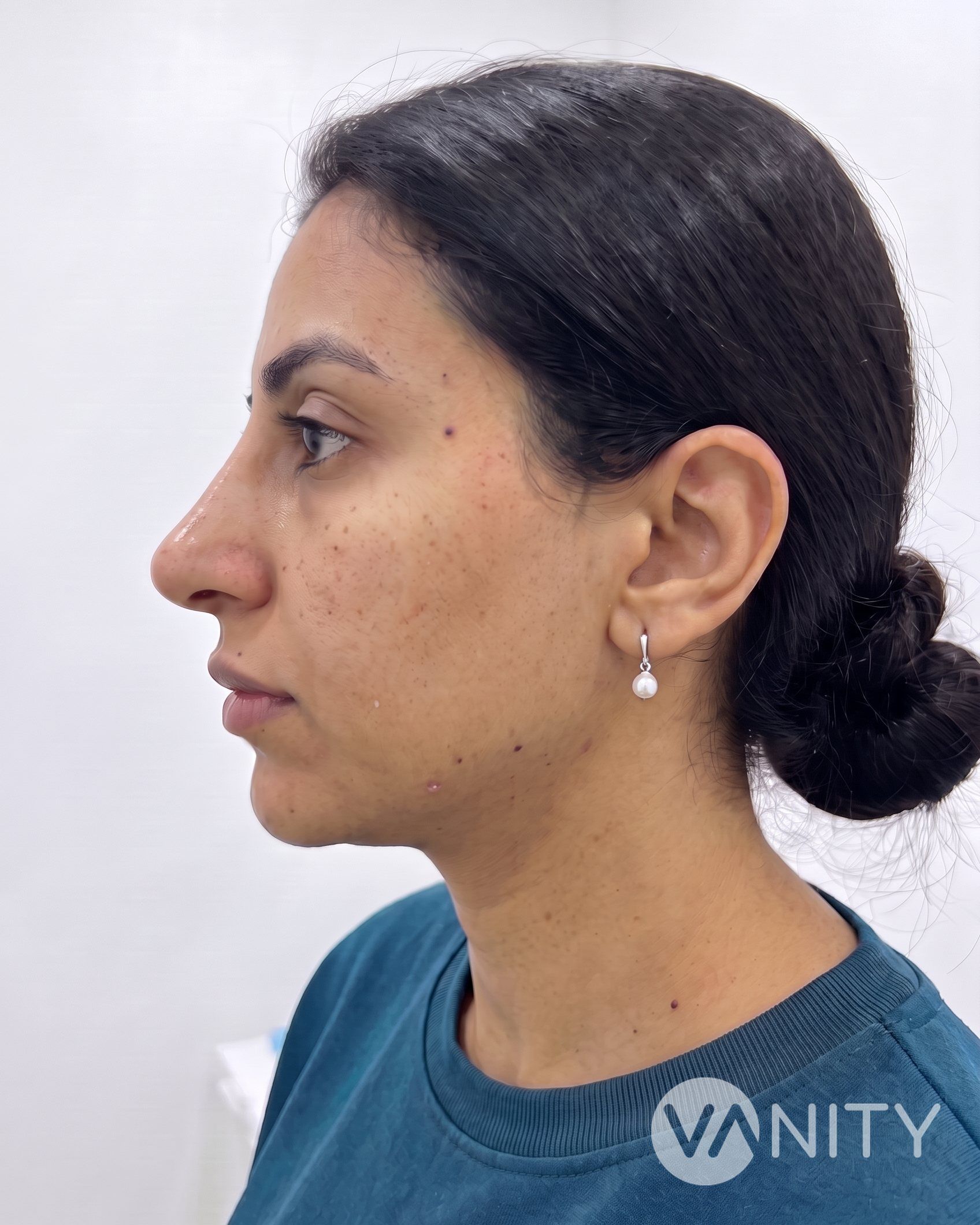 After Non-surgical rhinoplasty — illustrative, not a real patient