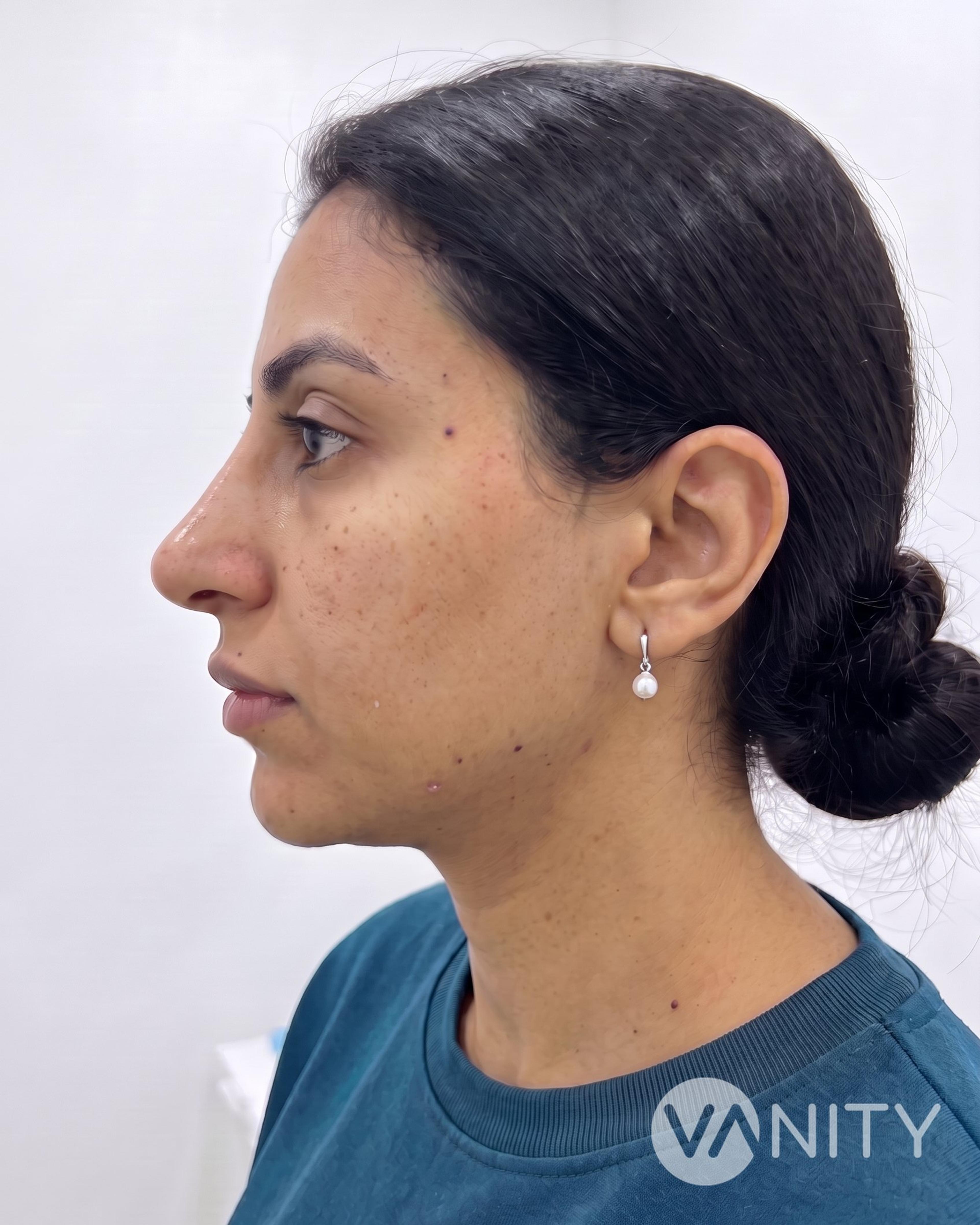 After Non-surgical rhinoplasty — illustrative, not a real patient
