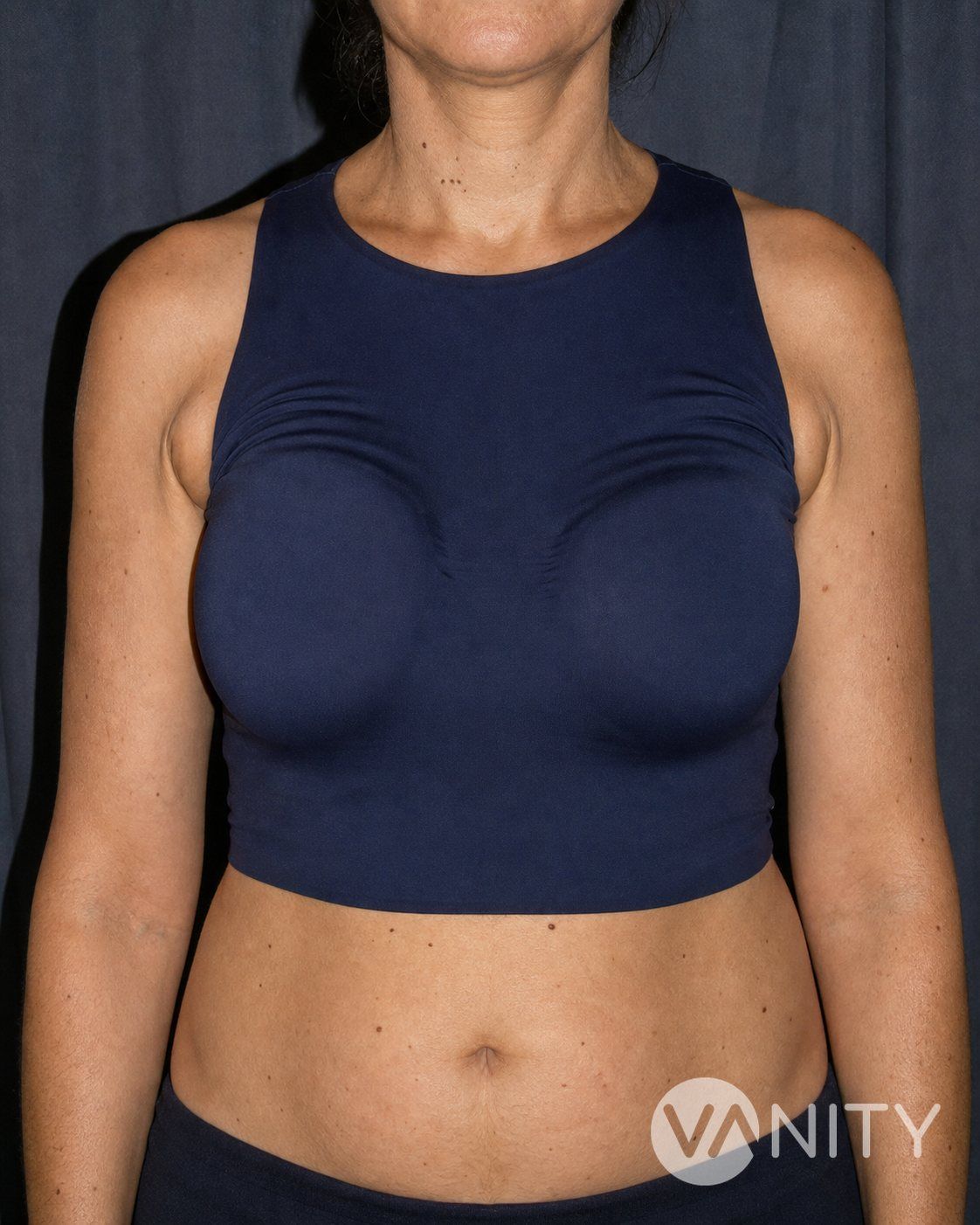 Before Breast Implant Revision (Removal or Replacement) — illustrative, not a real patient