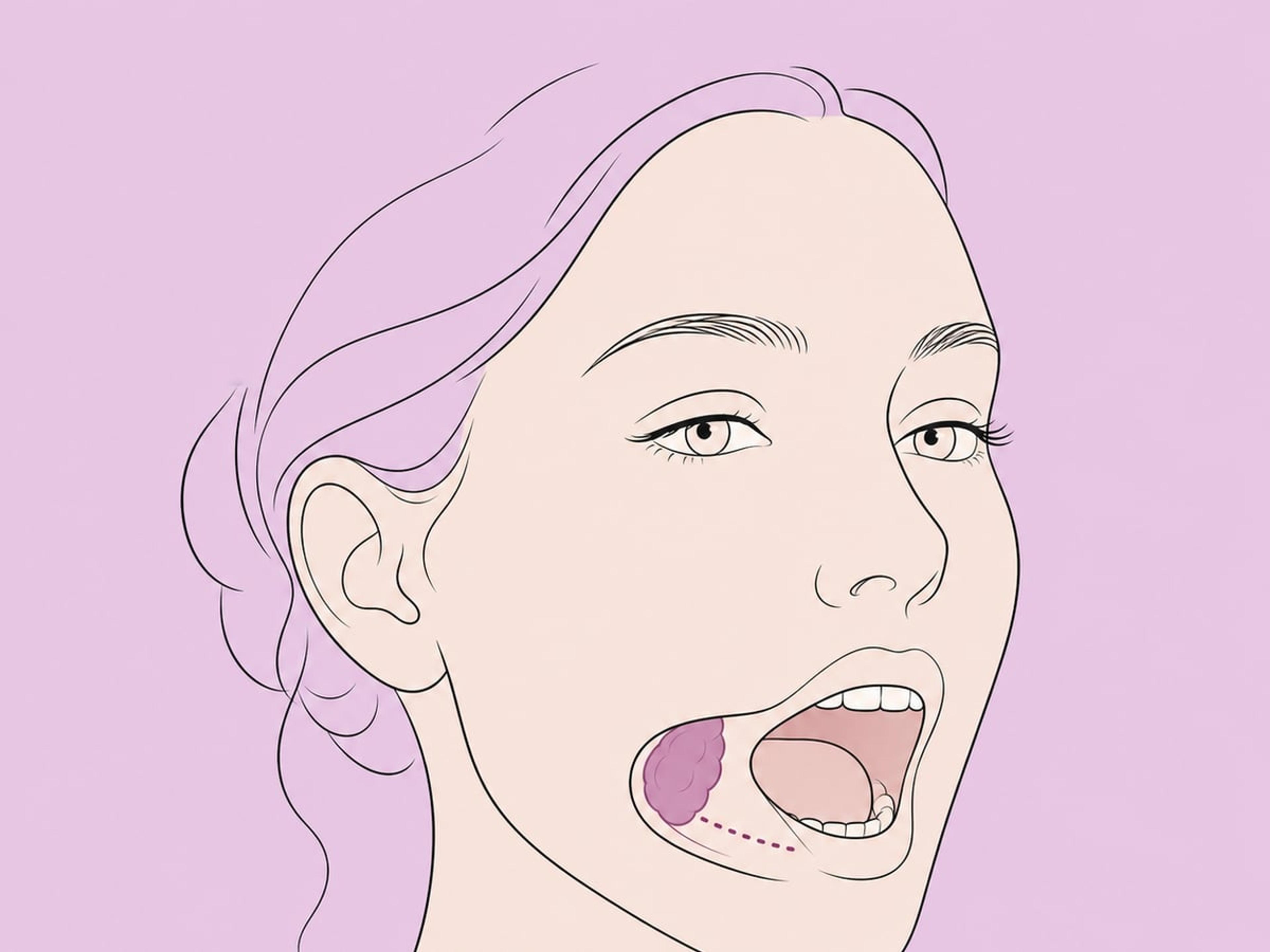 Standardmäßige intraorale Entfernung — illustration