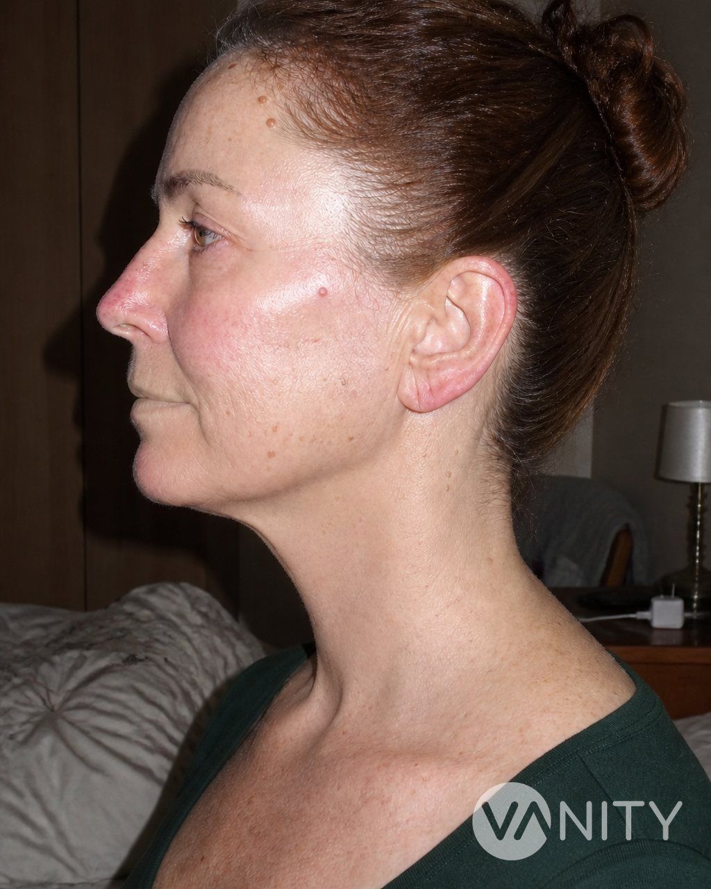 After Platysmaplasty — illustrative, not a real patient