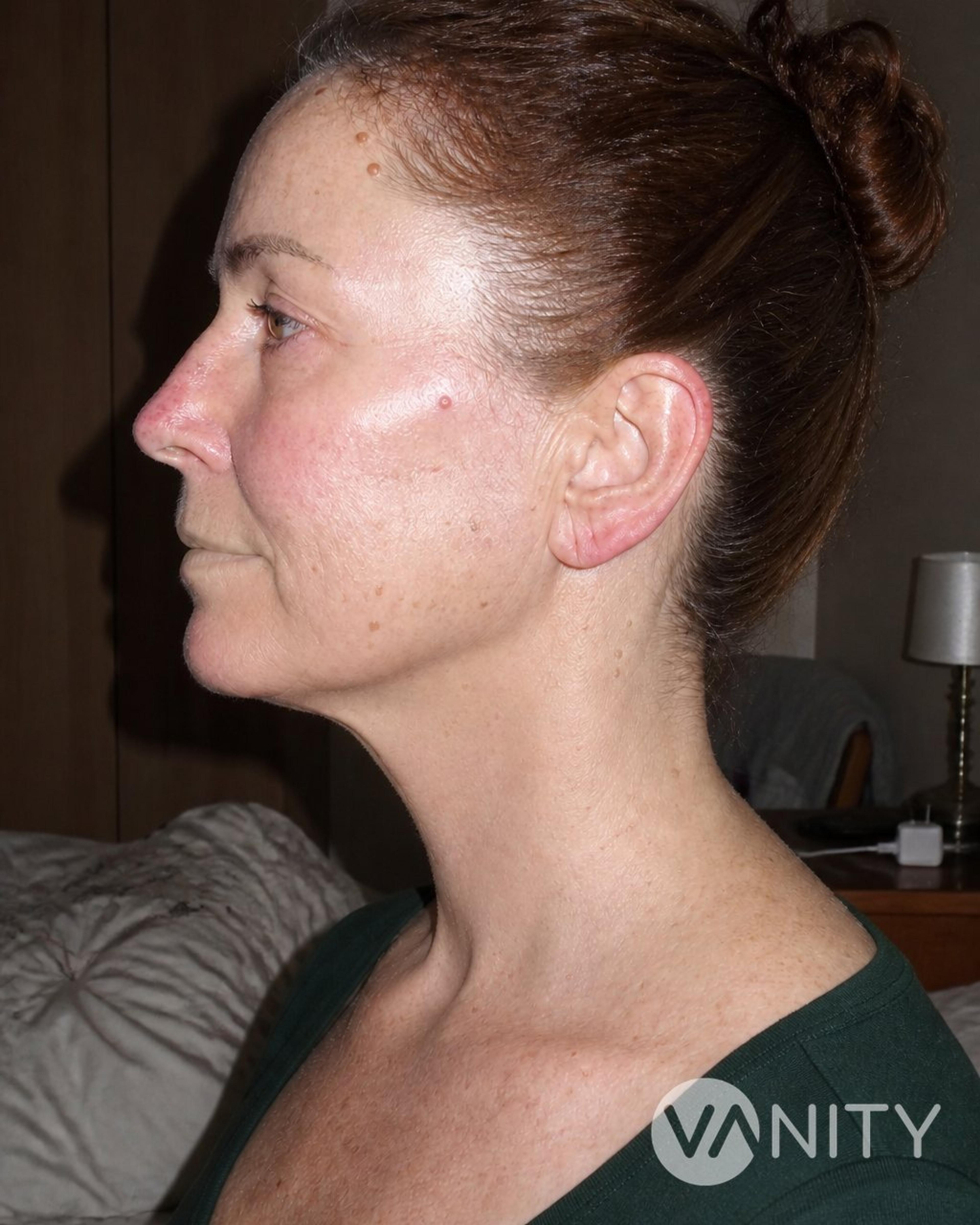 After Platysmaplasty — illustrative, not a real patient