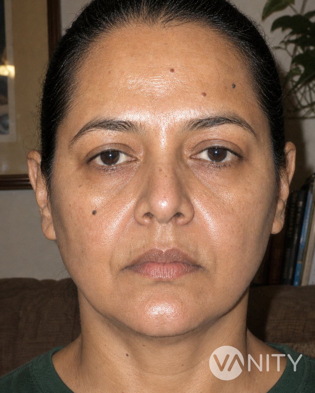After Face thread lift — illustrative, not a real patient