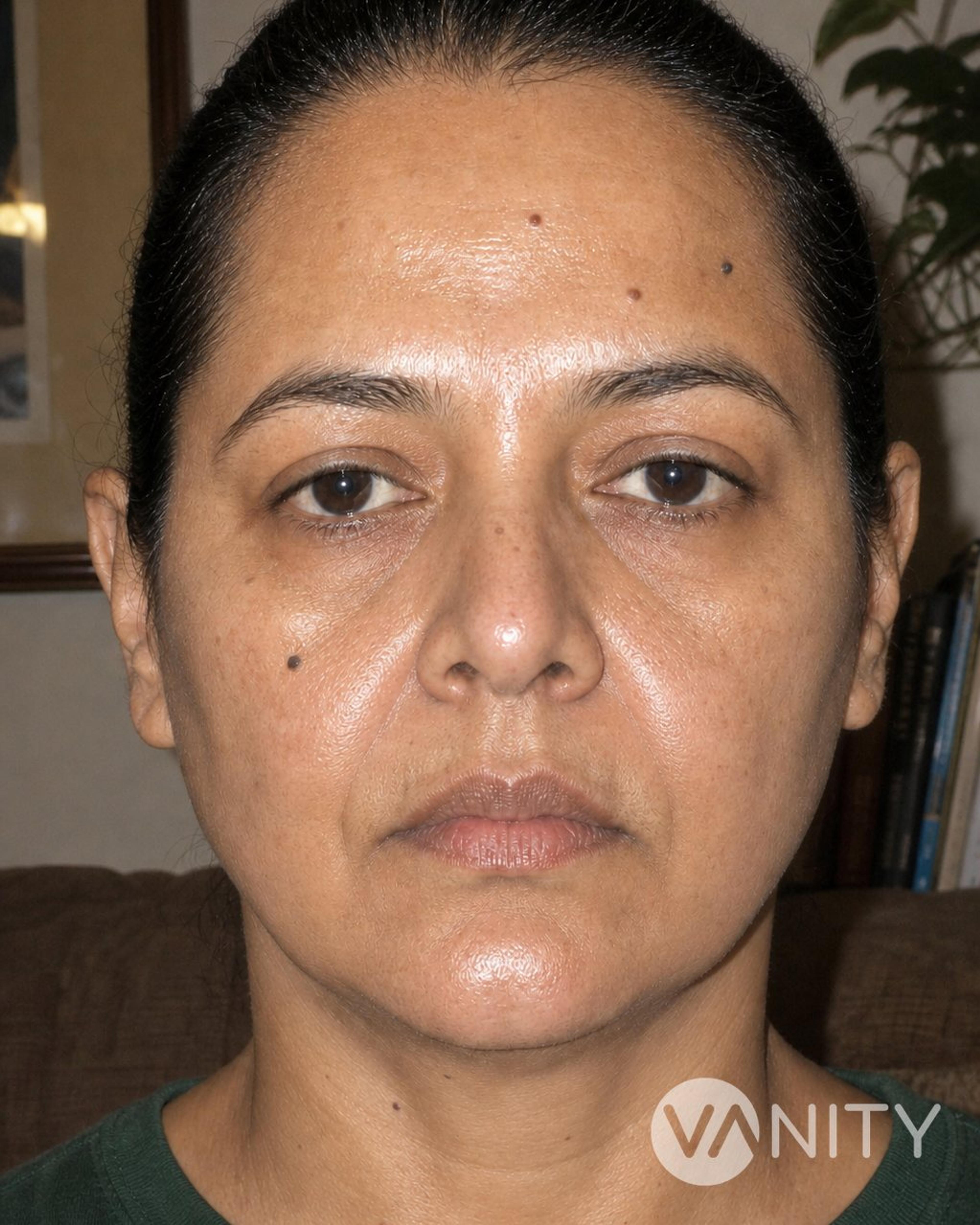 After Face thread lift — illustrative, not a real patient