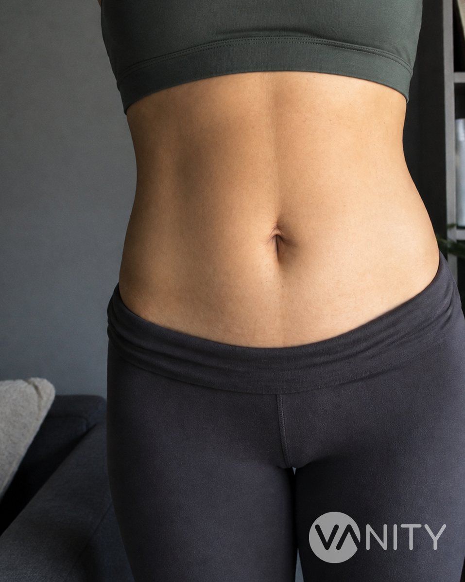 After Tummy tuck — illustrative, not a real patient