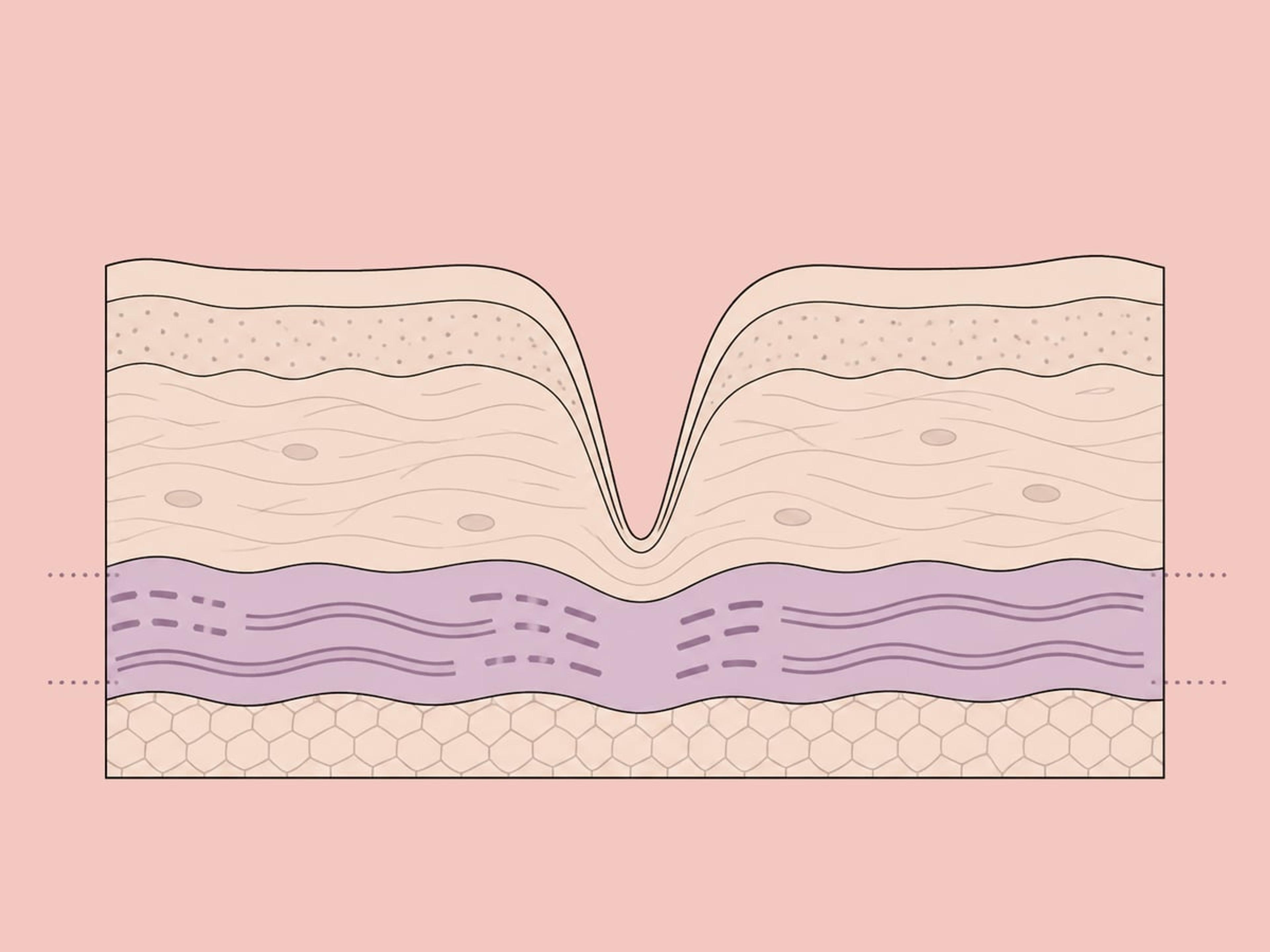 Kollagen-Injektionen — illustration