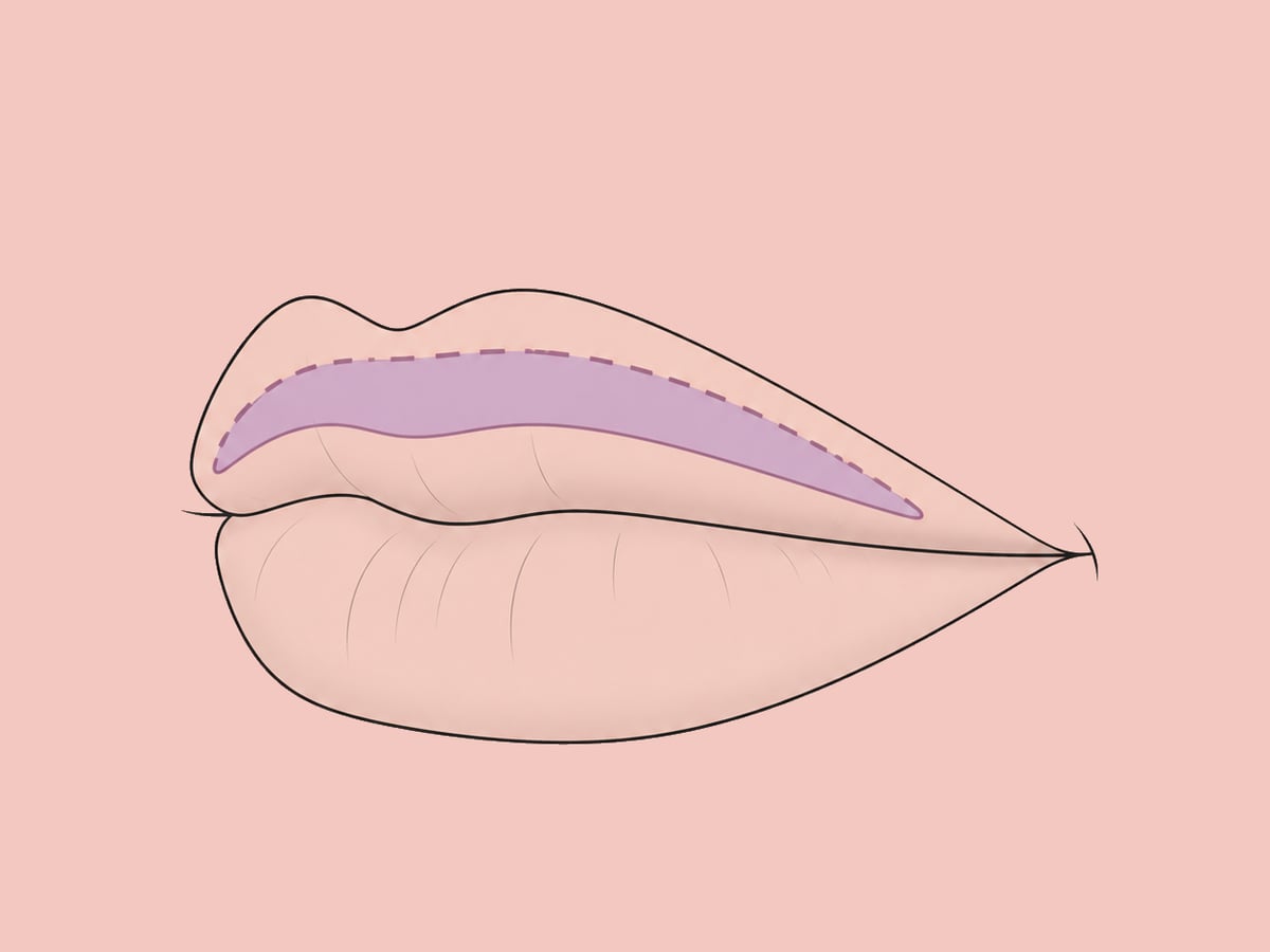 Impianti labiali — illustration
