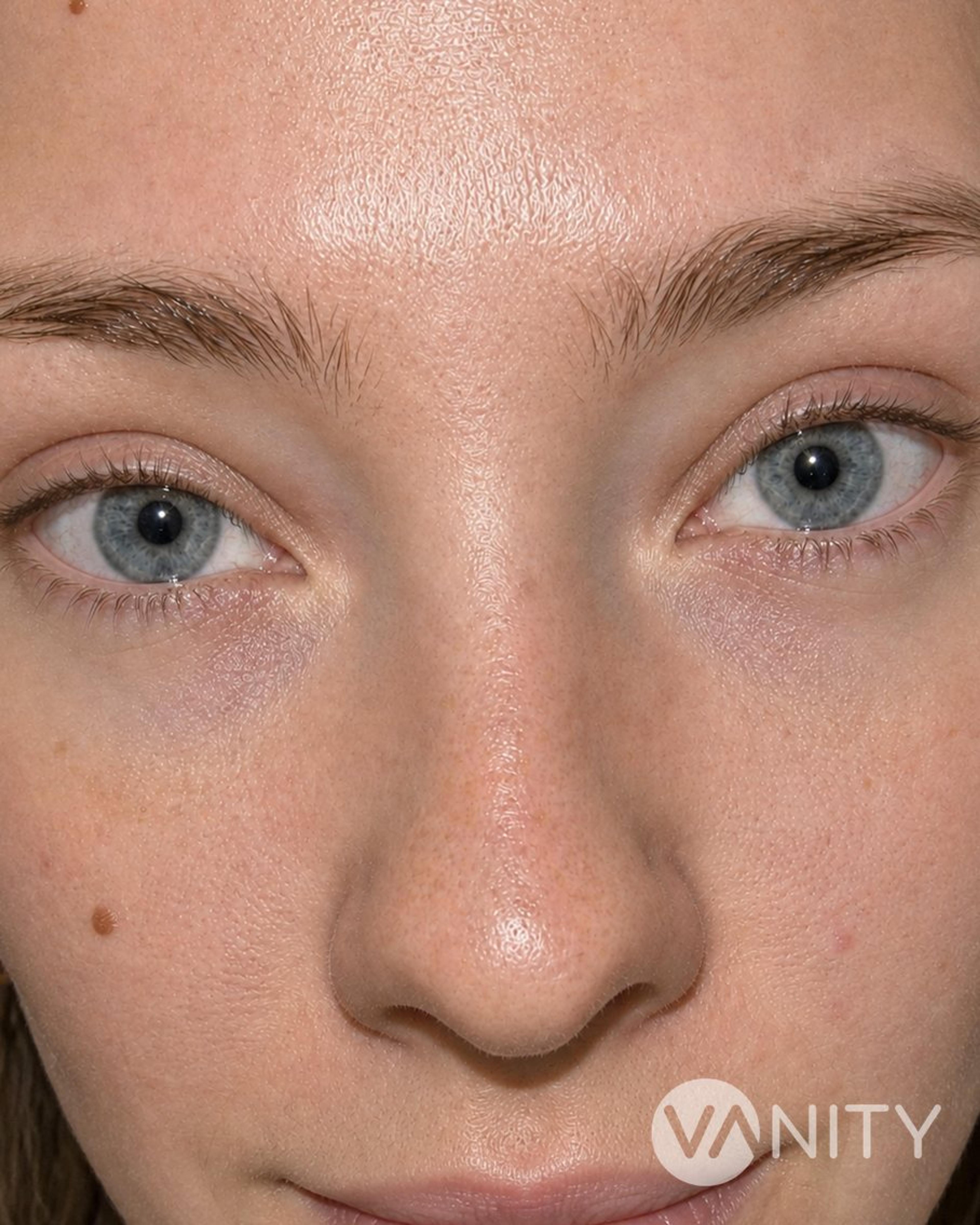 After Canthopexy: Fox Eye (Almond eye ) Surgery — illustrative, not a real patient