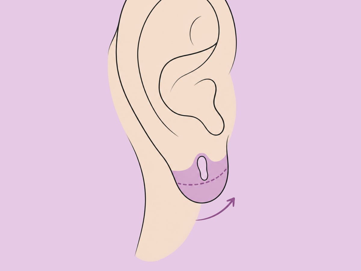 Ohrläppchenverkleinerung oder -rekonstruktion — illustration
