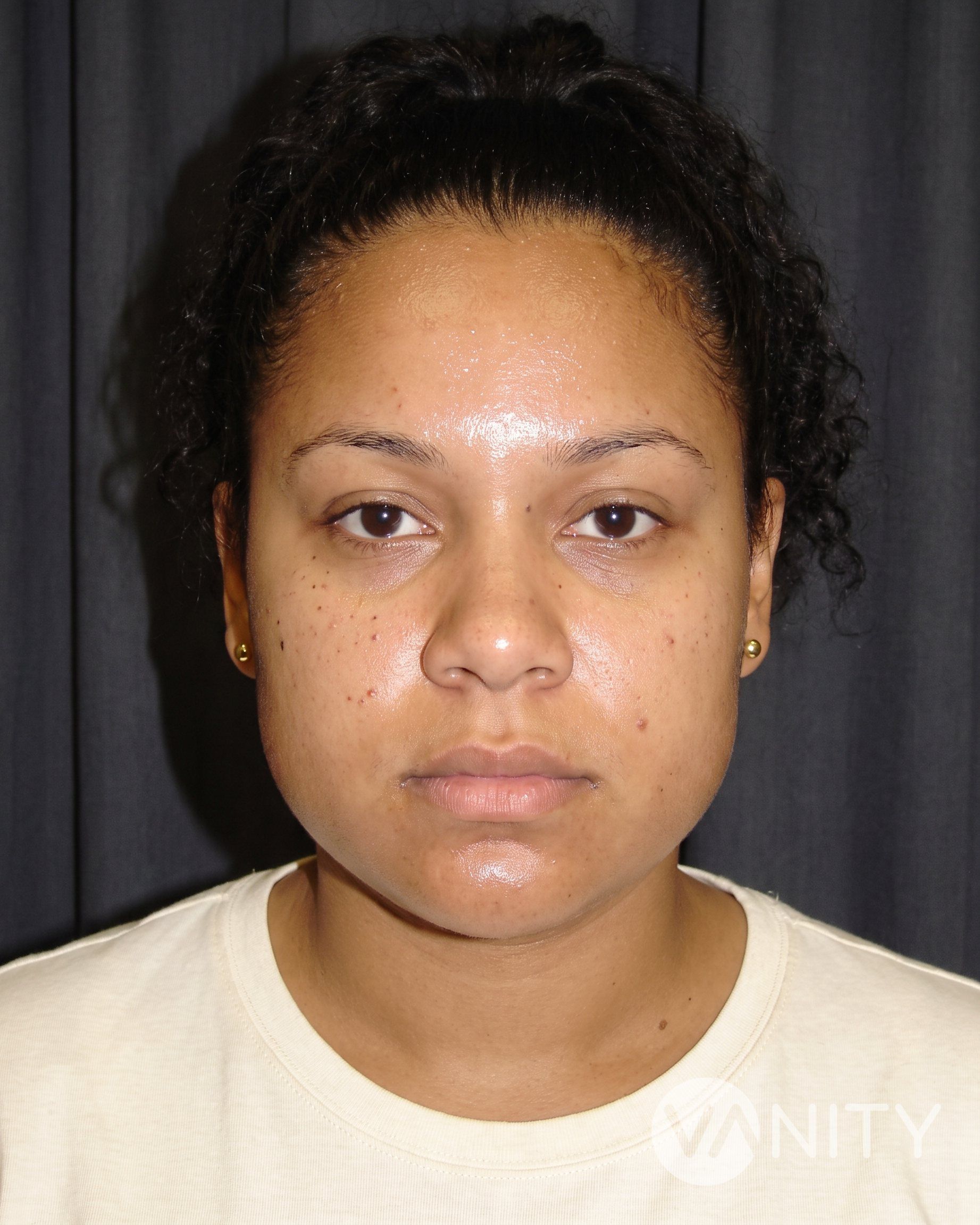 Before Buccal fat removal — illustrative, not a real patient