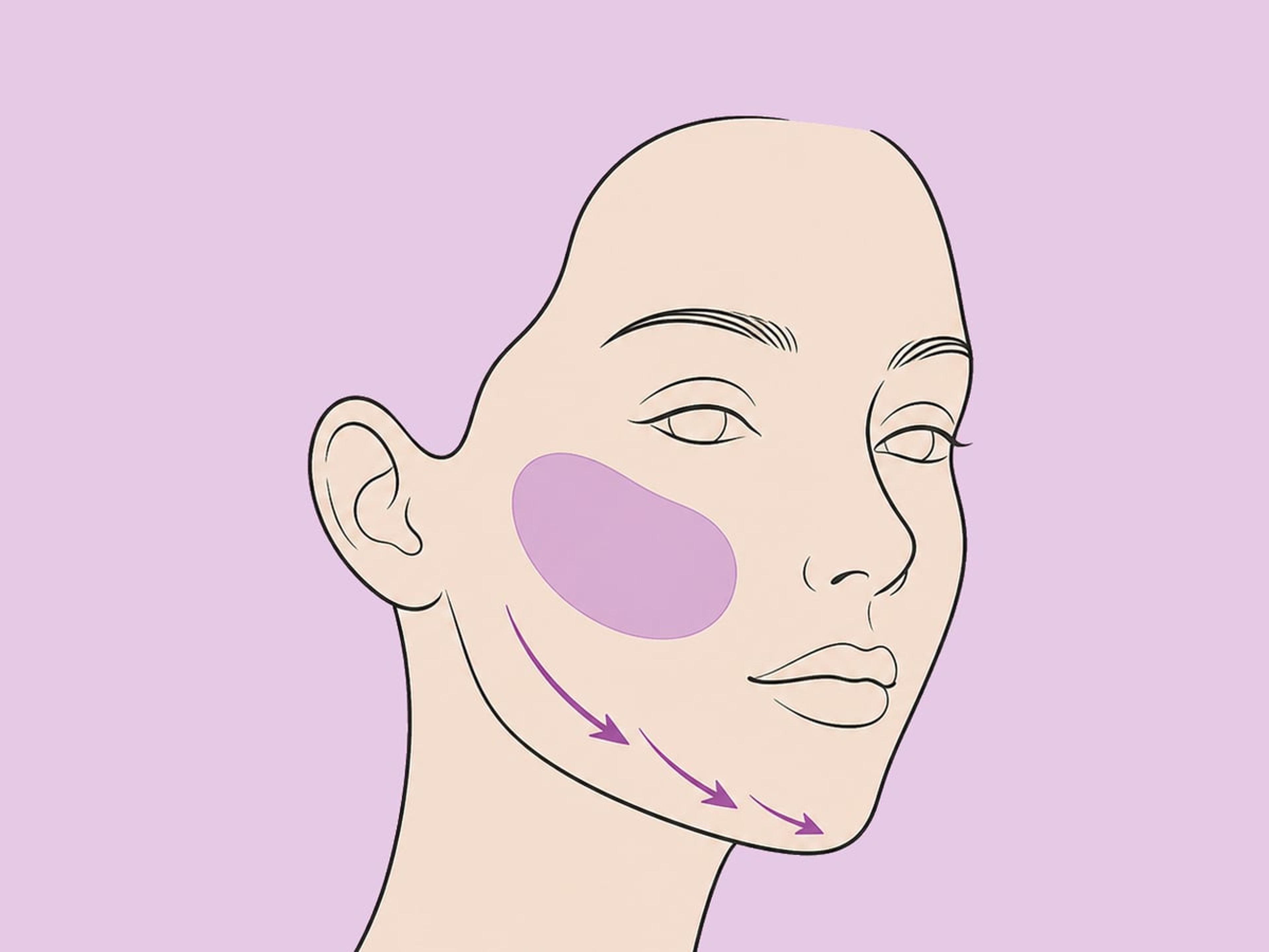 Kombiniert mit Facelift oder Kinn- und Kieferbehandlung — illustration