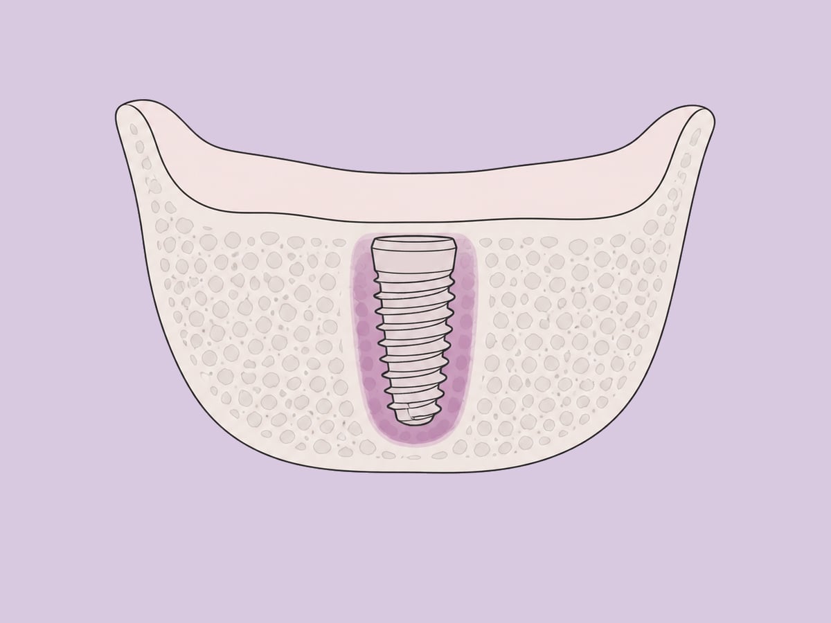 وضع على مرحلتين (مغمور) مع تحميل تقليدي — illustration