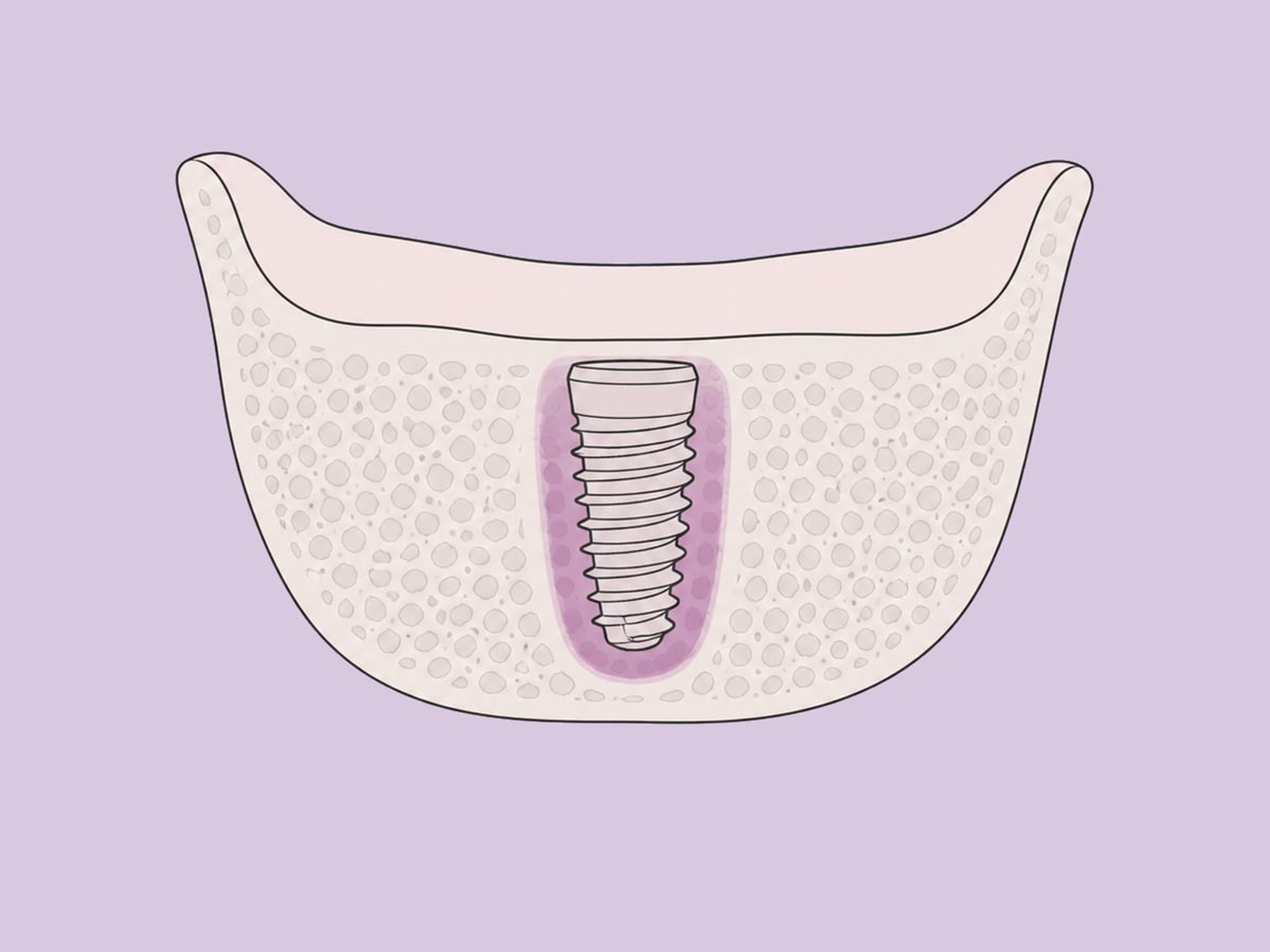وضع على مرحلتين (مغمور) مع تحميل تقليدي — illustration