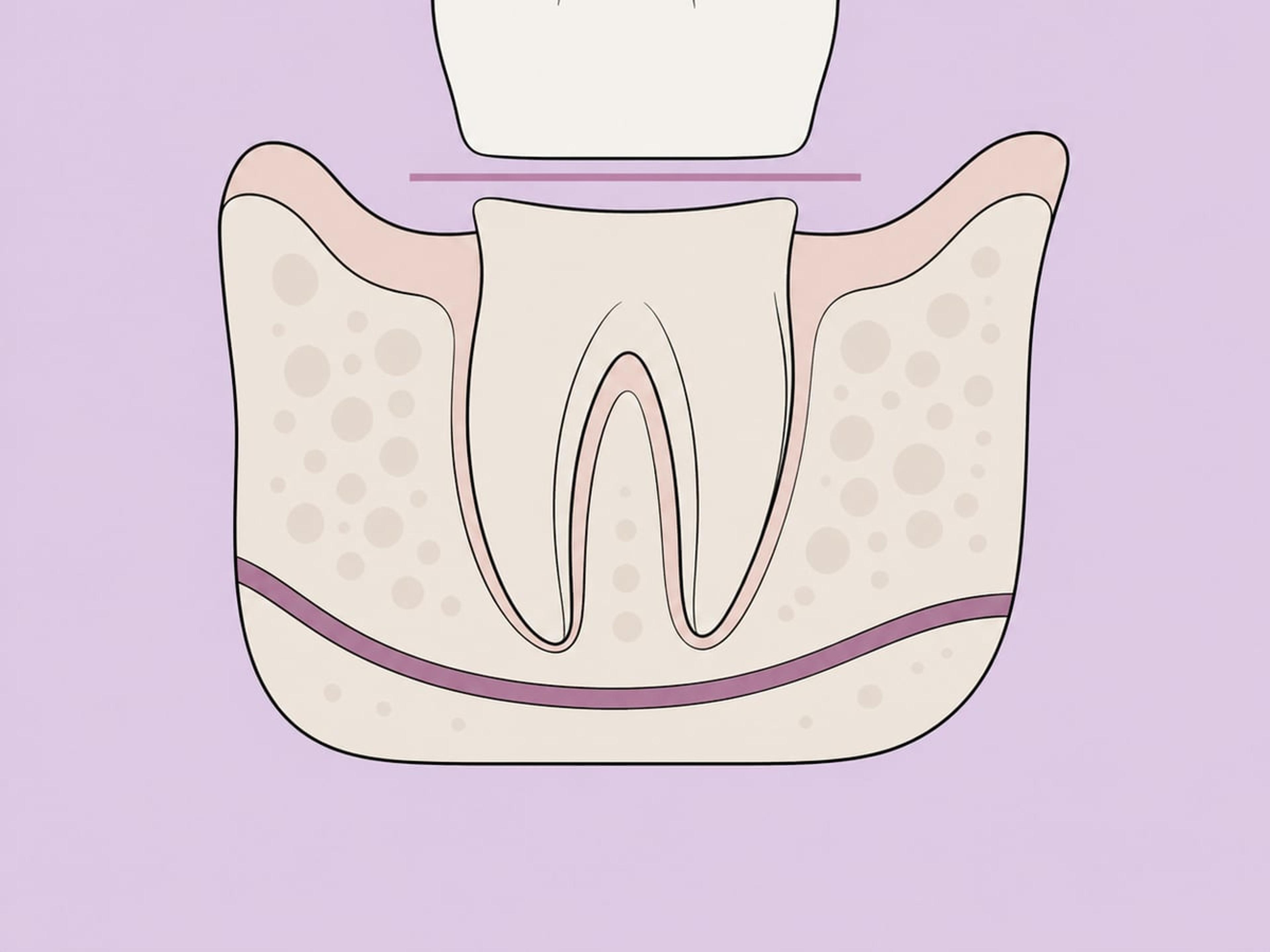 Coronectomy — illustration
