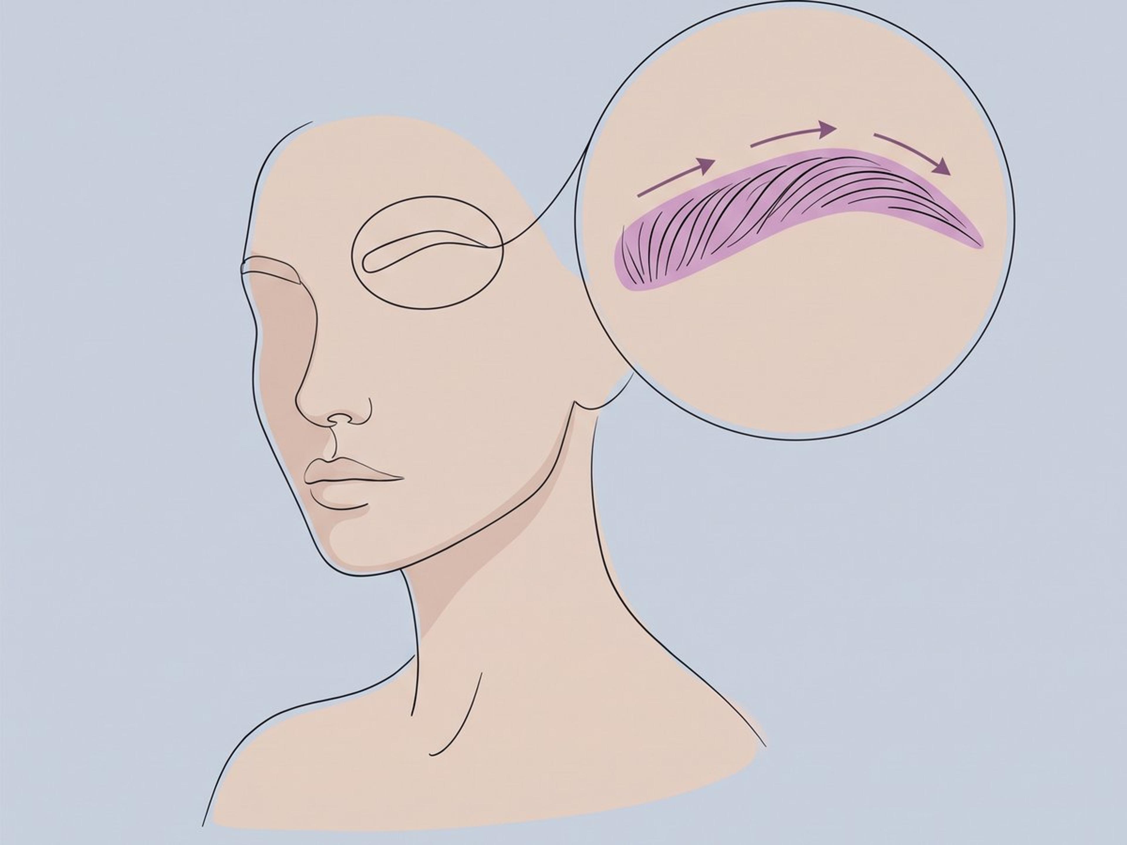 Long-hair Follicular Unit Excision (LHF) — illustration