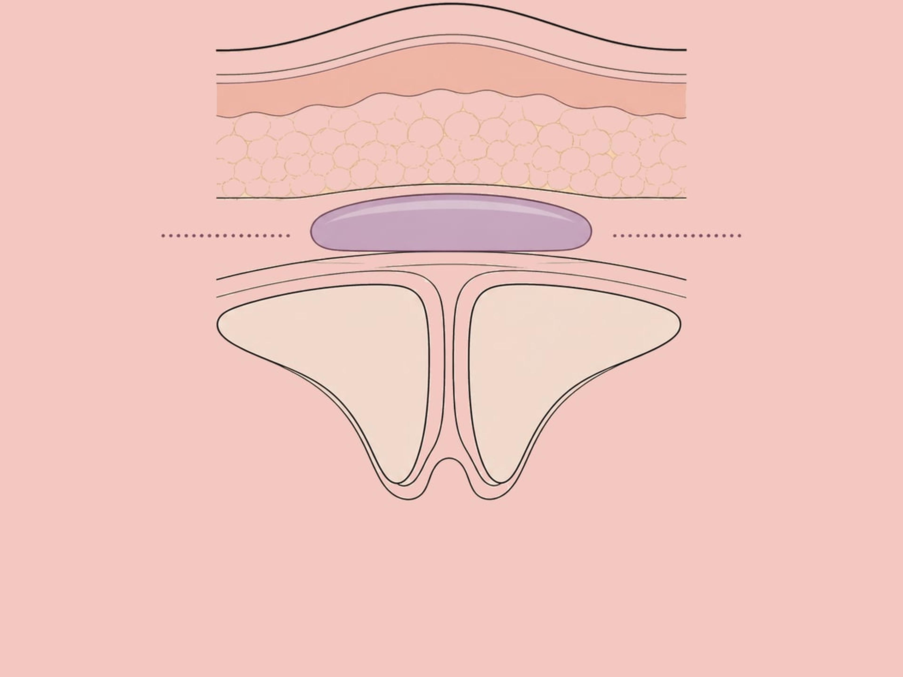 Auflösen mit Hyaluronidase — illustration