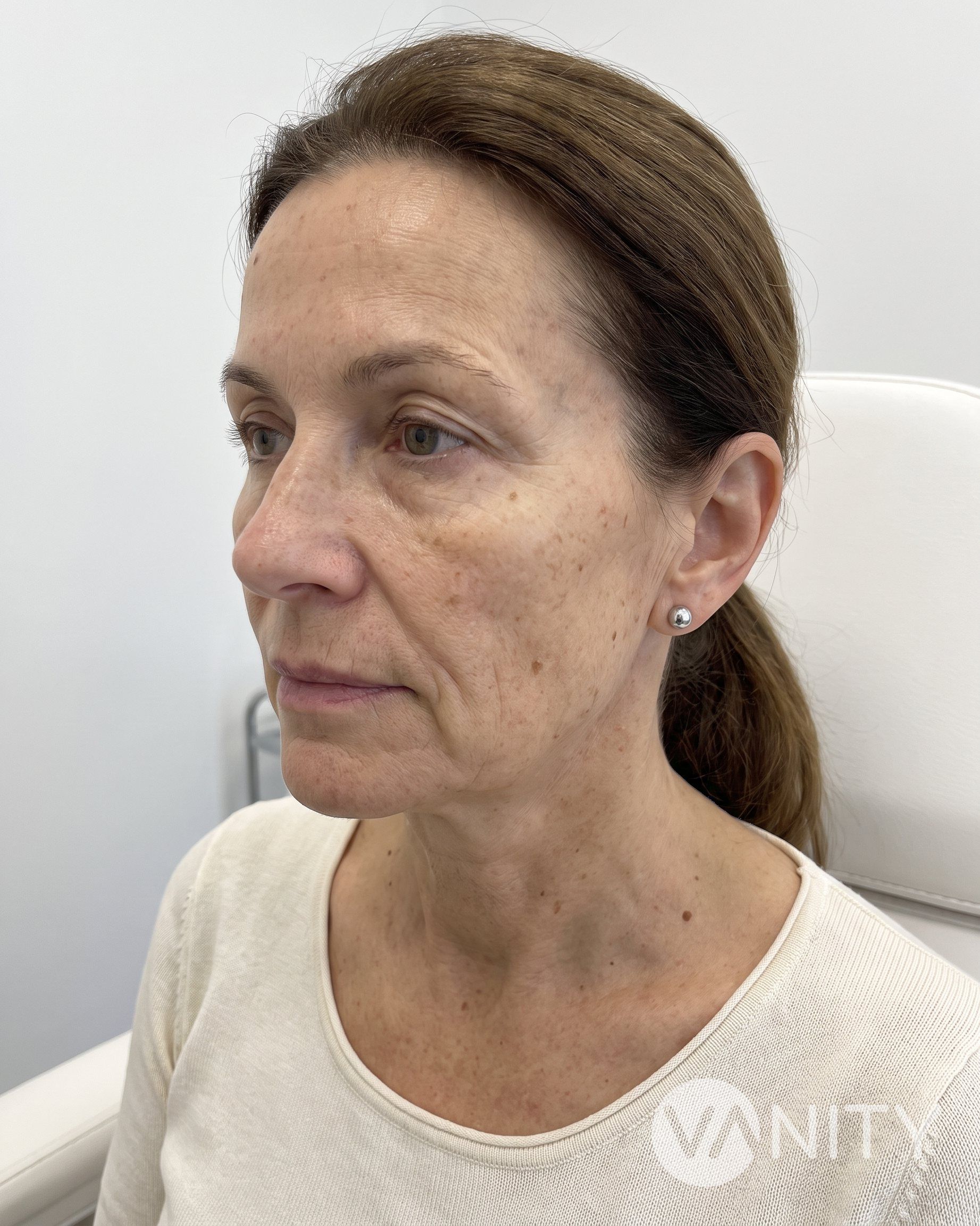Before Collagen biostimulators — illustrative, not a real patient