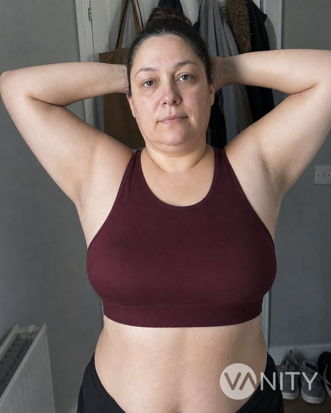 After Accessory breast removal — illustrative, not a real patient