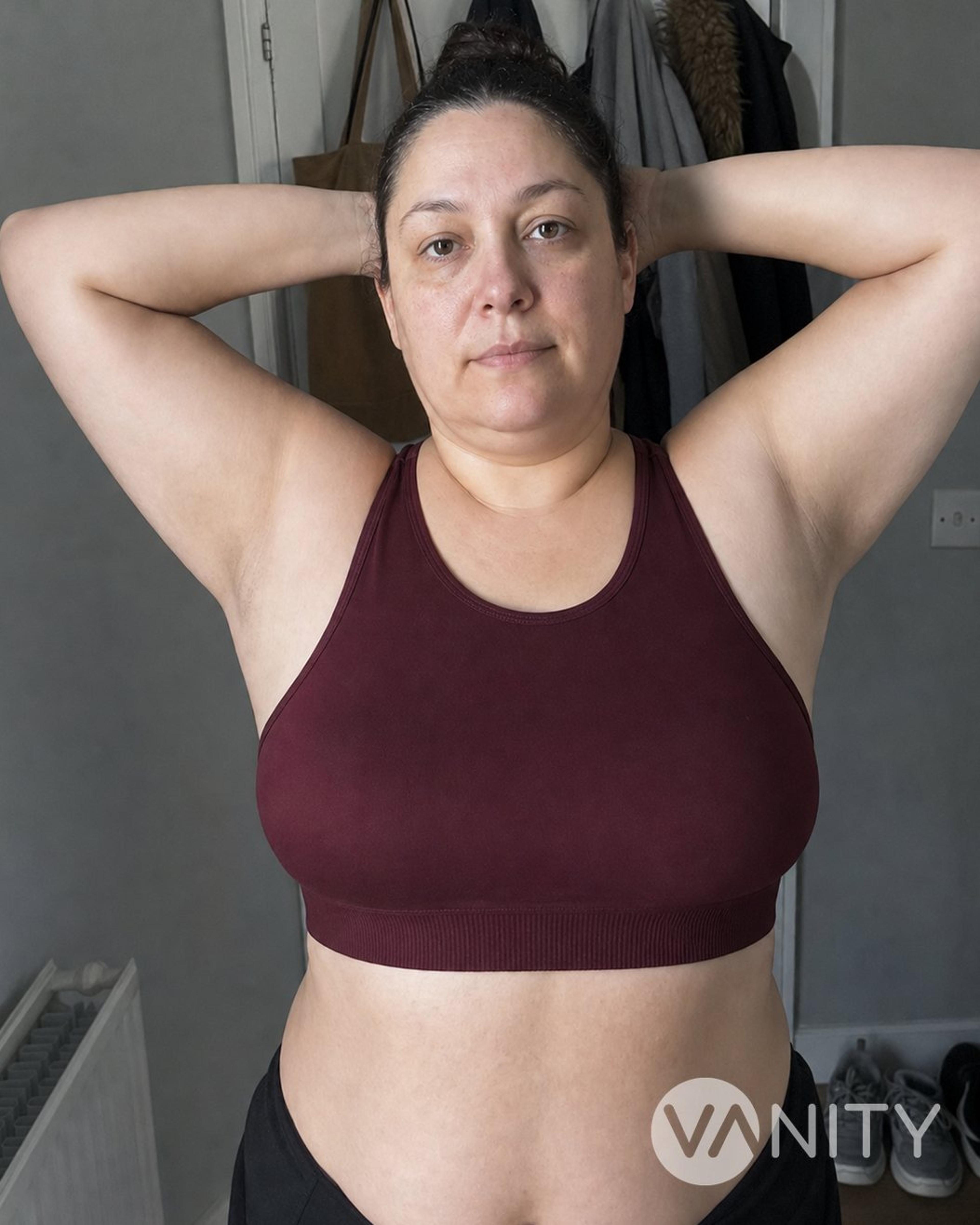 After Accessory breast removal — illustrative, not a real patient