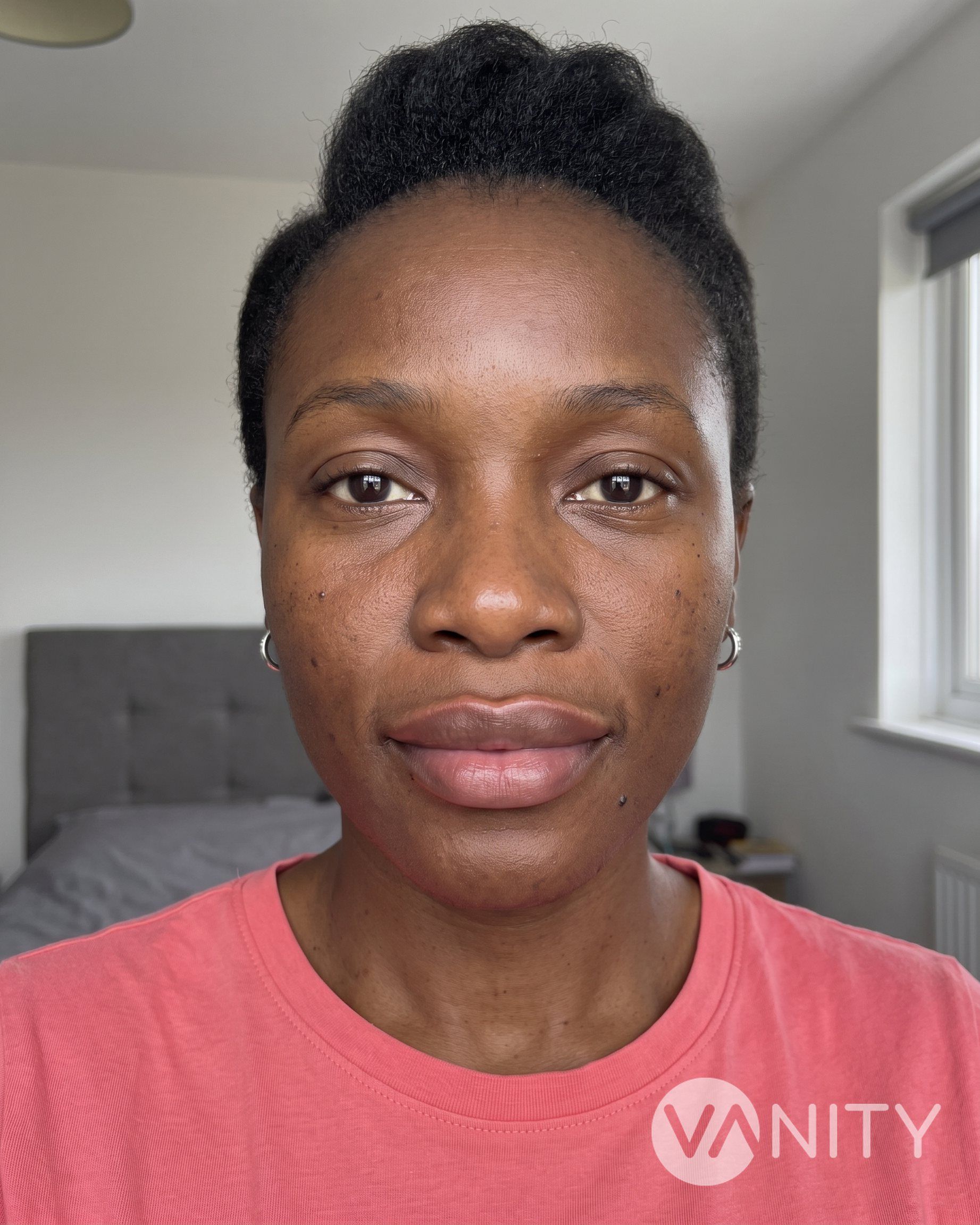After Lip fillers — illustrative, not a real patient