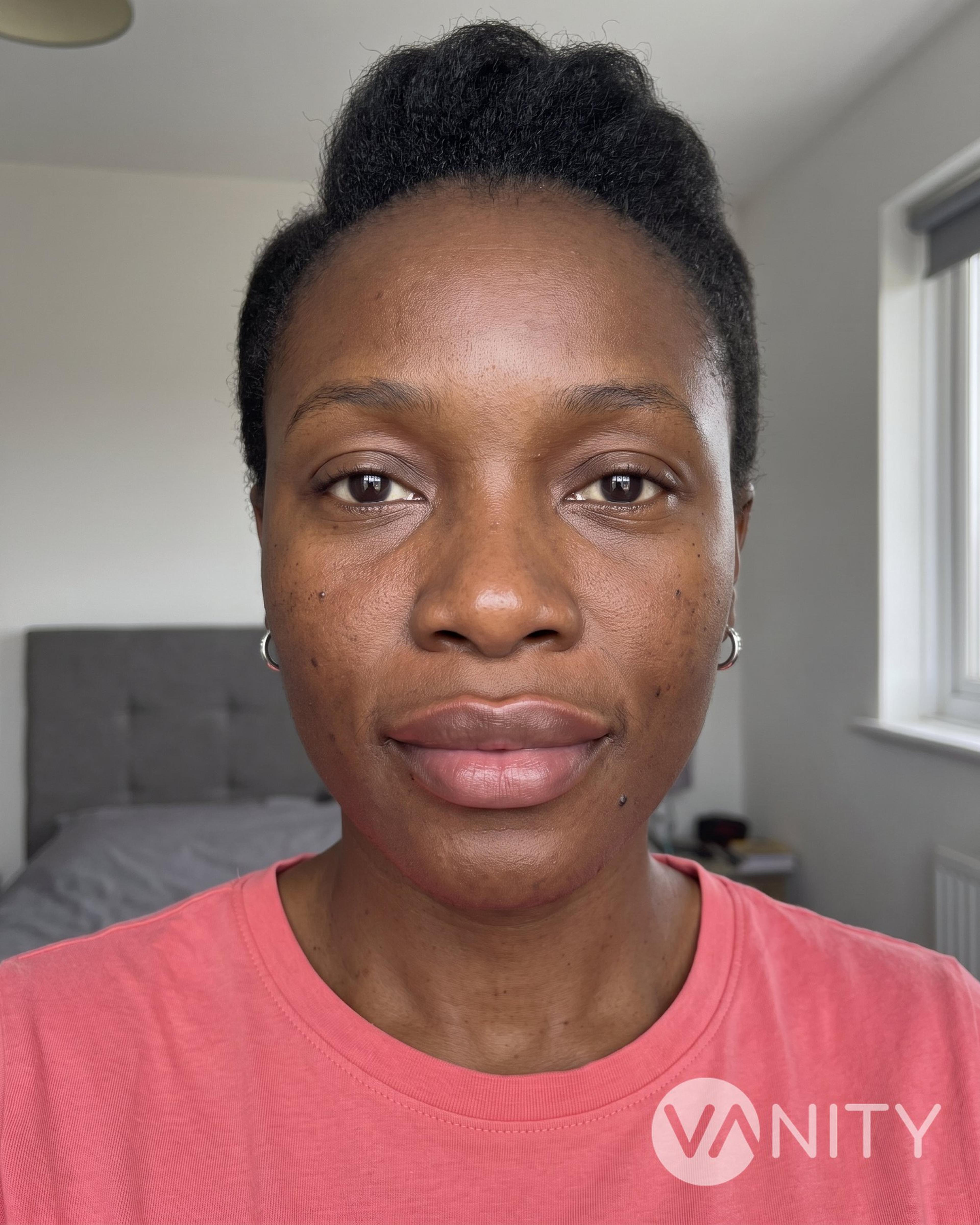 After Lip fillers — illustrative, not a real patient