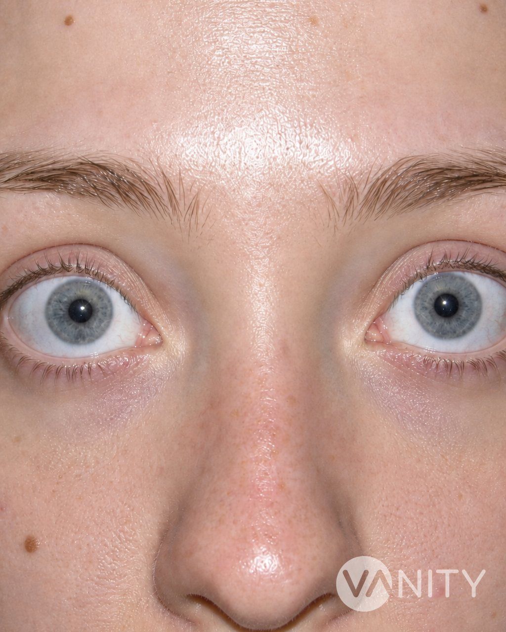 Before Canthopexy: Fox Eye (Almond eye ) Surgery — illustrative, not a real patient