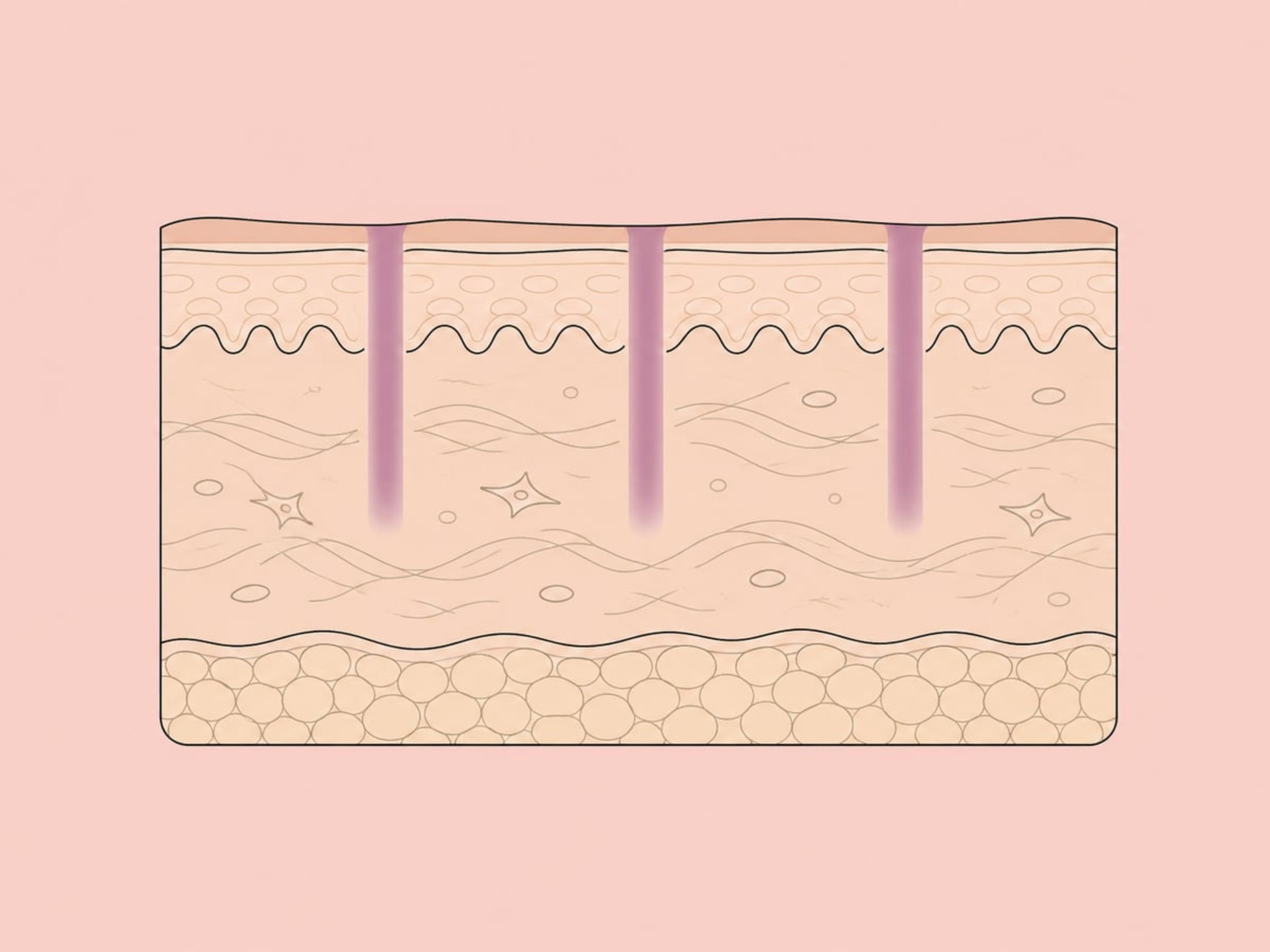 Nicht-ablatives fraktioniertes Resurfacing (1.440–1.550 nm) — illustration